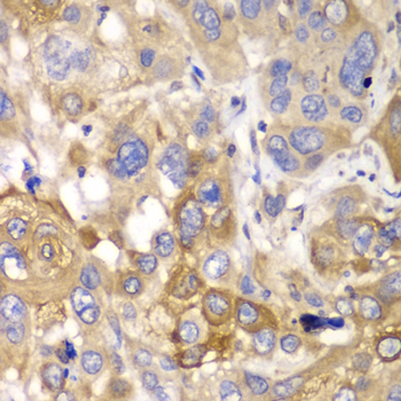 Immunohistochemistry of paraffin-embedded human esophageal cancer using PPP1CB antibody (15-047) at dilution of 1:100 (40x lens) .