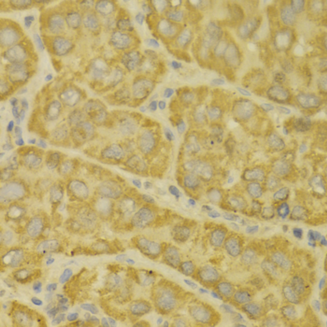 Immunohistochemistry of paraffin-embedded human liver cancer using MAOA antibody (15-055) at dilution of 1:100 (40x lens) .