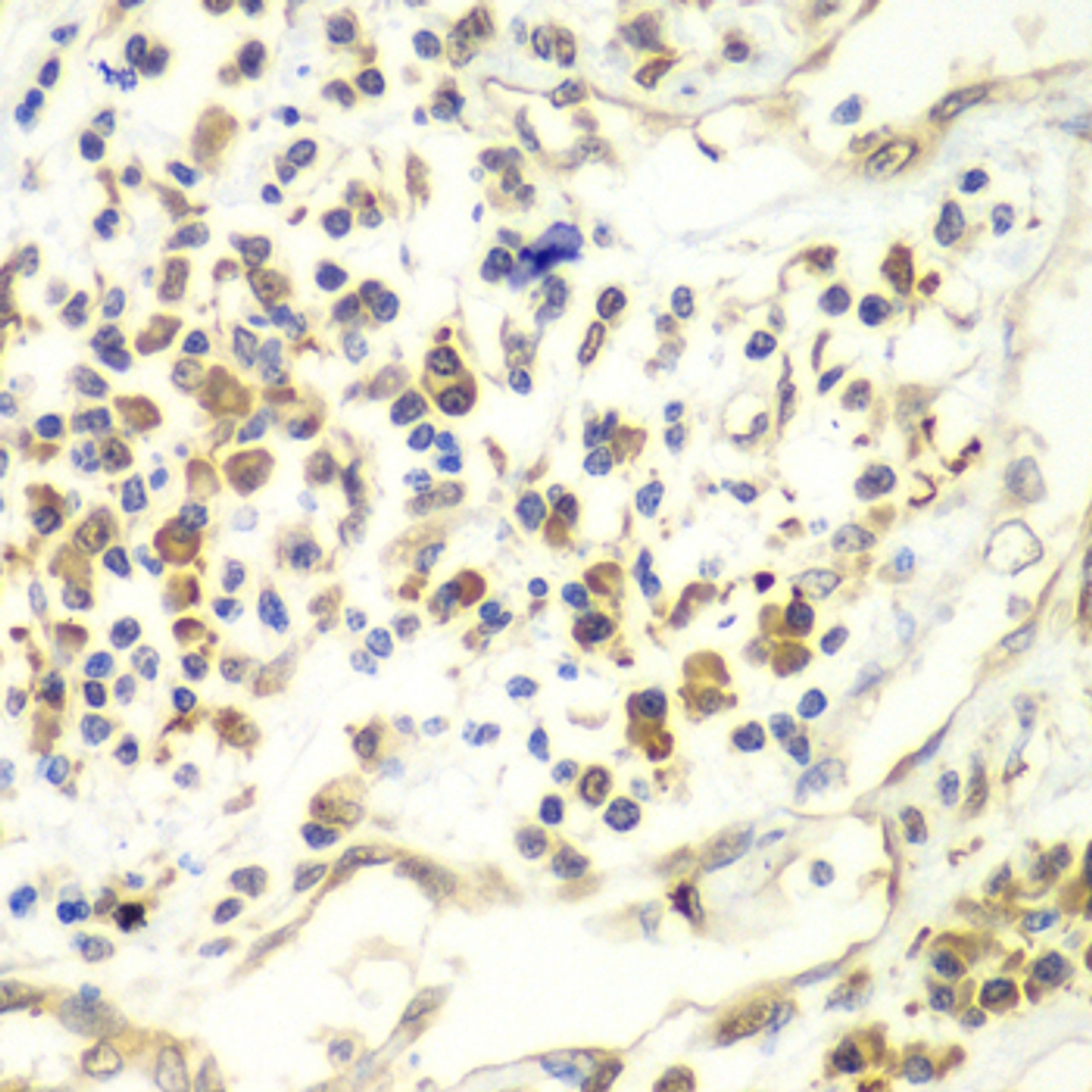 Immunohistochemistry of paraffin-embedded human liver cancer using UPF1 antibody (15-057) at dilution of 1:100 (40x lens) .