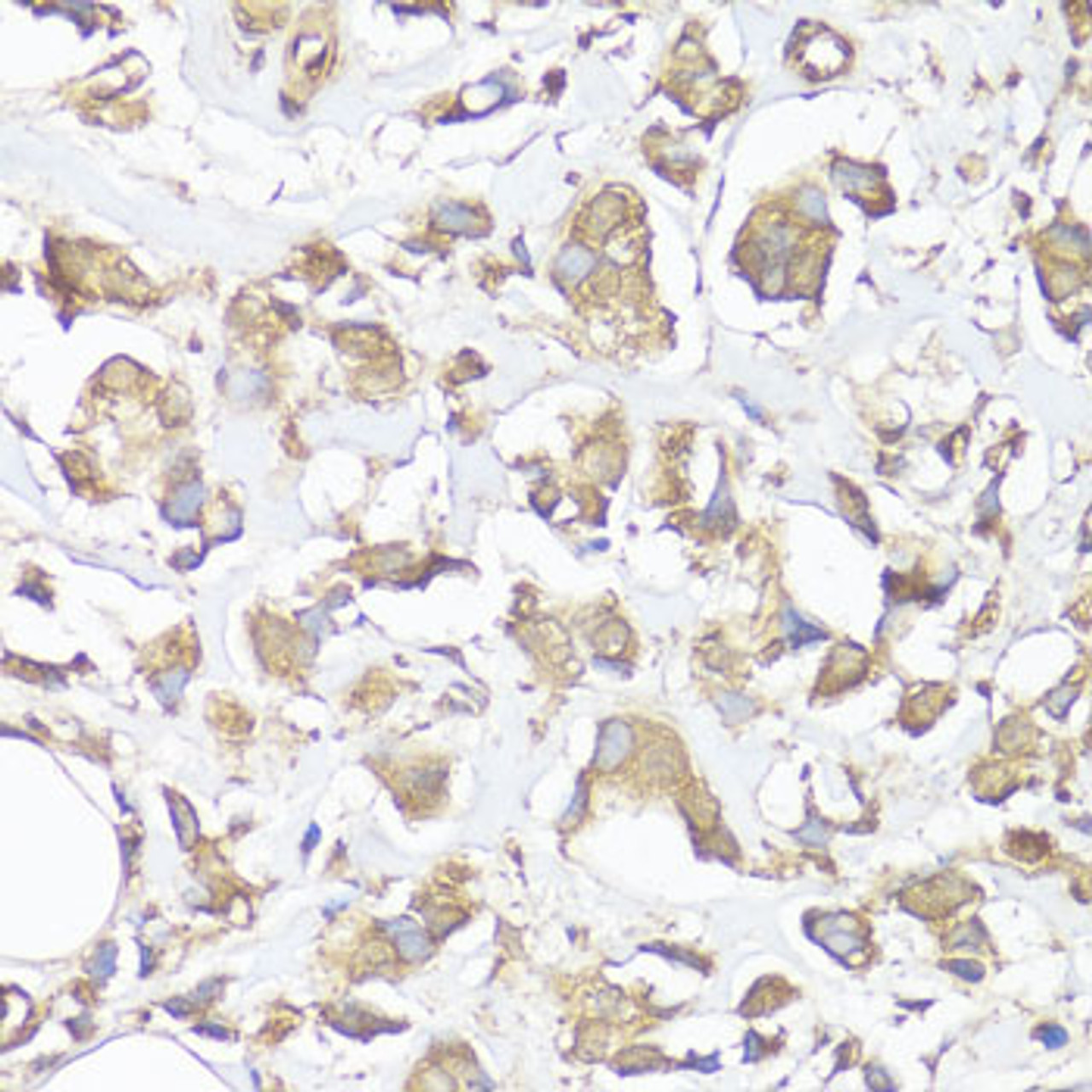 Immunohistochemistry of paraffin-embedded human mammary cancer using VTN antibody (15-070) at dilution of 1:100 (40x lens) .