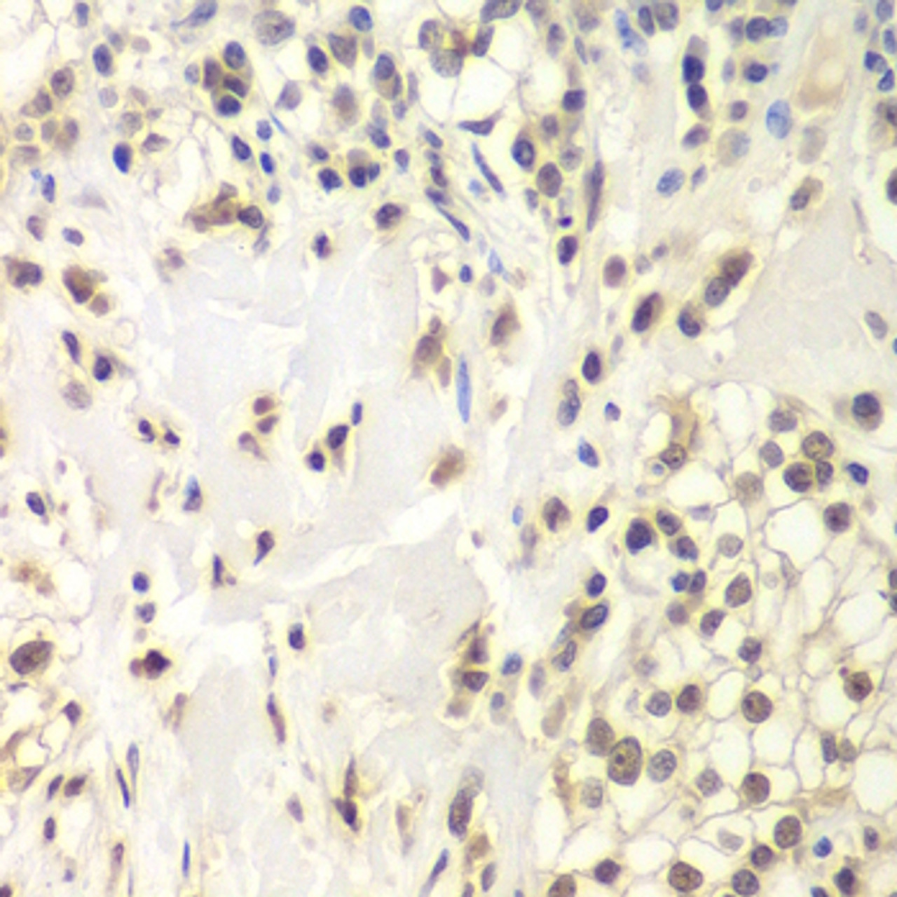 Immunohistochemistry of paraffin-embedded human kidney cancer using HAUSP / USP7 antibody (15-072) at dilution of 1:200 (40x lens) .