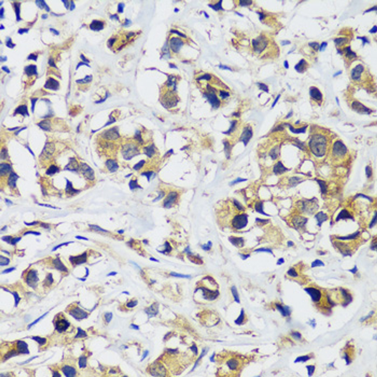 Immunohistochemistry of paraffin-embedded human breast cancer using CAMLG antibody (15-165) at dilution of 1:100 (40x lens) .