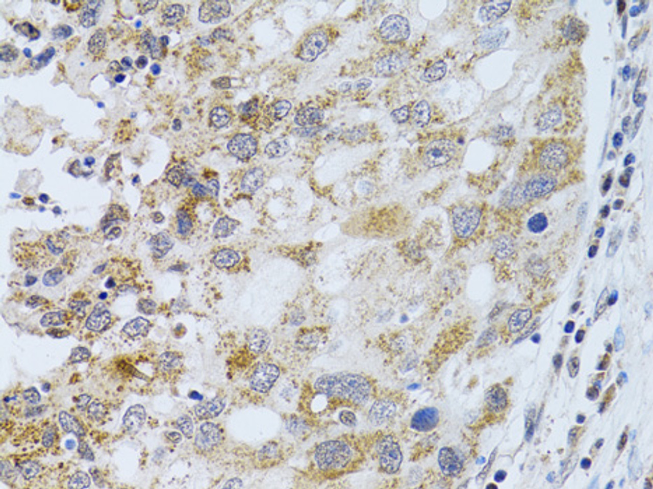 Immunohistochemistry of paraffin-embedded human breast cancer using PHLDA2 antibody (15-268) at dilution of 1:100 (40x lens) .