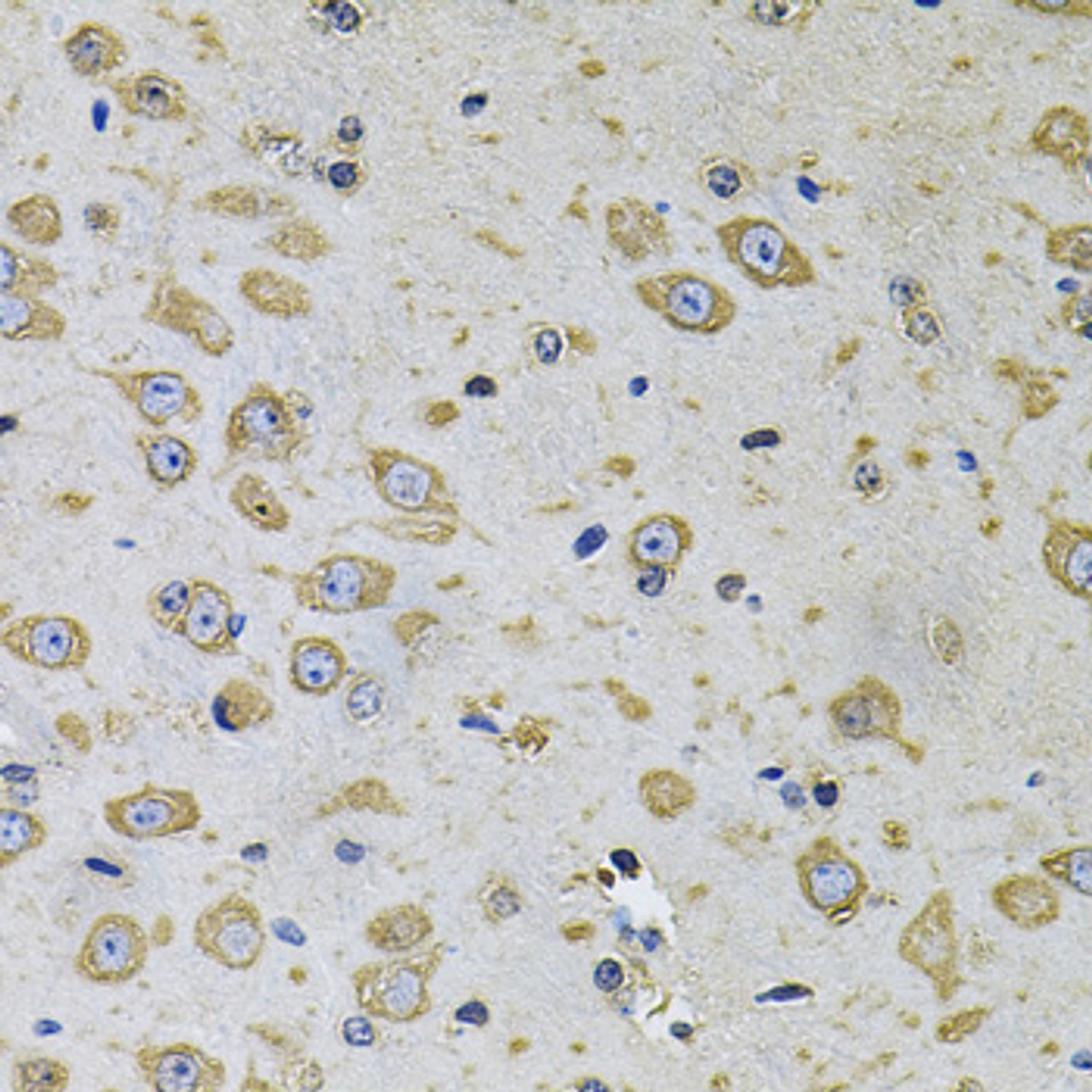 Immunohistochemistry of paraffin-embedded human gastric cancer using RhoA Antibody (15-286) at dilution of 1:100 (40x lens) .