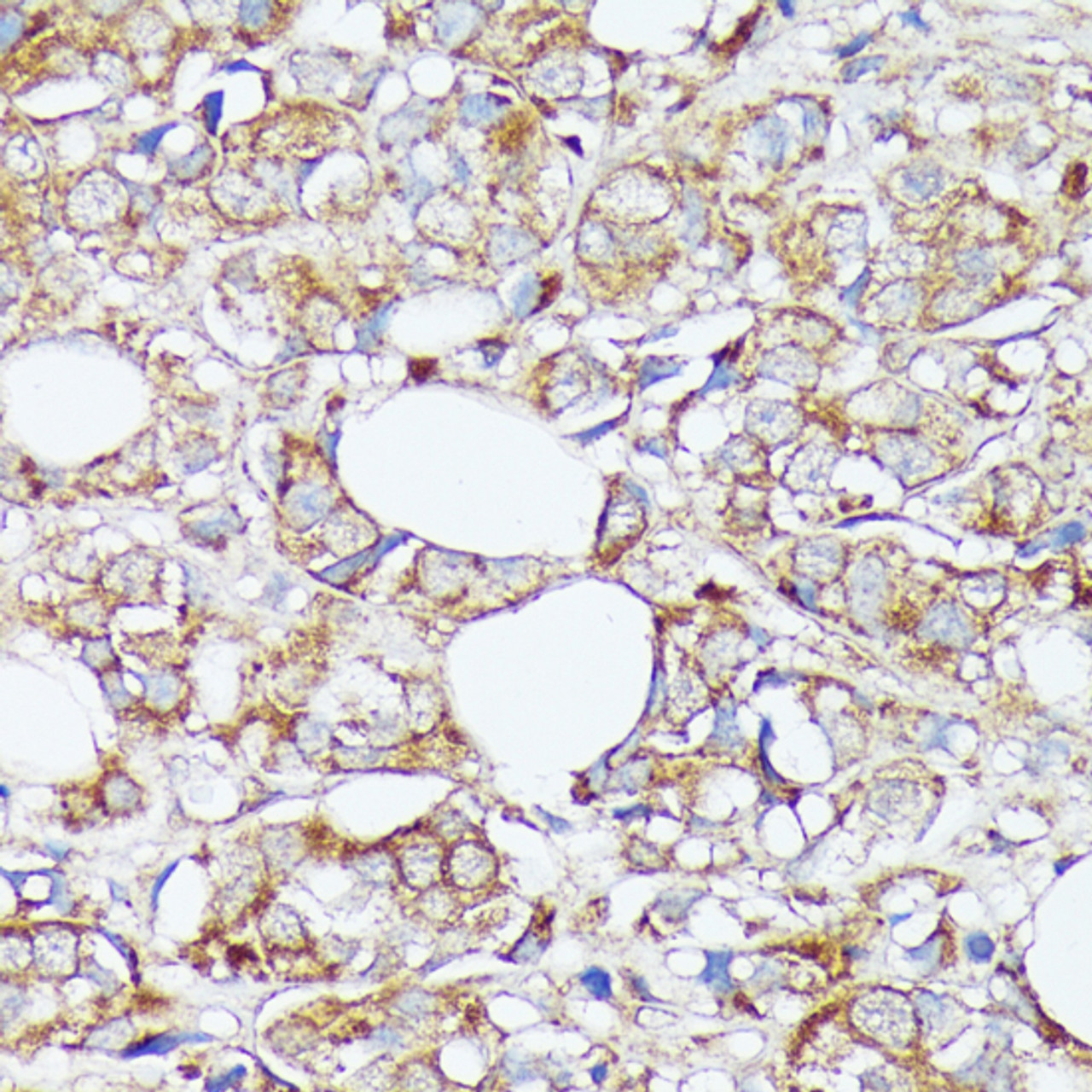 Immunohistochemistry of paraffin-embedded human mammary cancer using SLC7A2 antibody (15-611) at dilution of 1:100 (40x lens) .