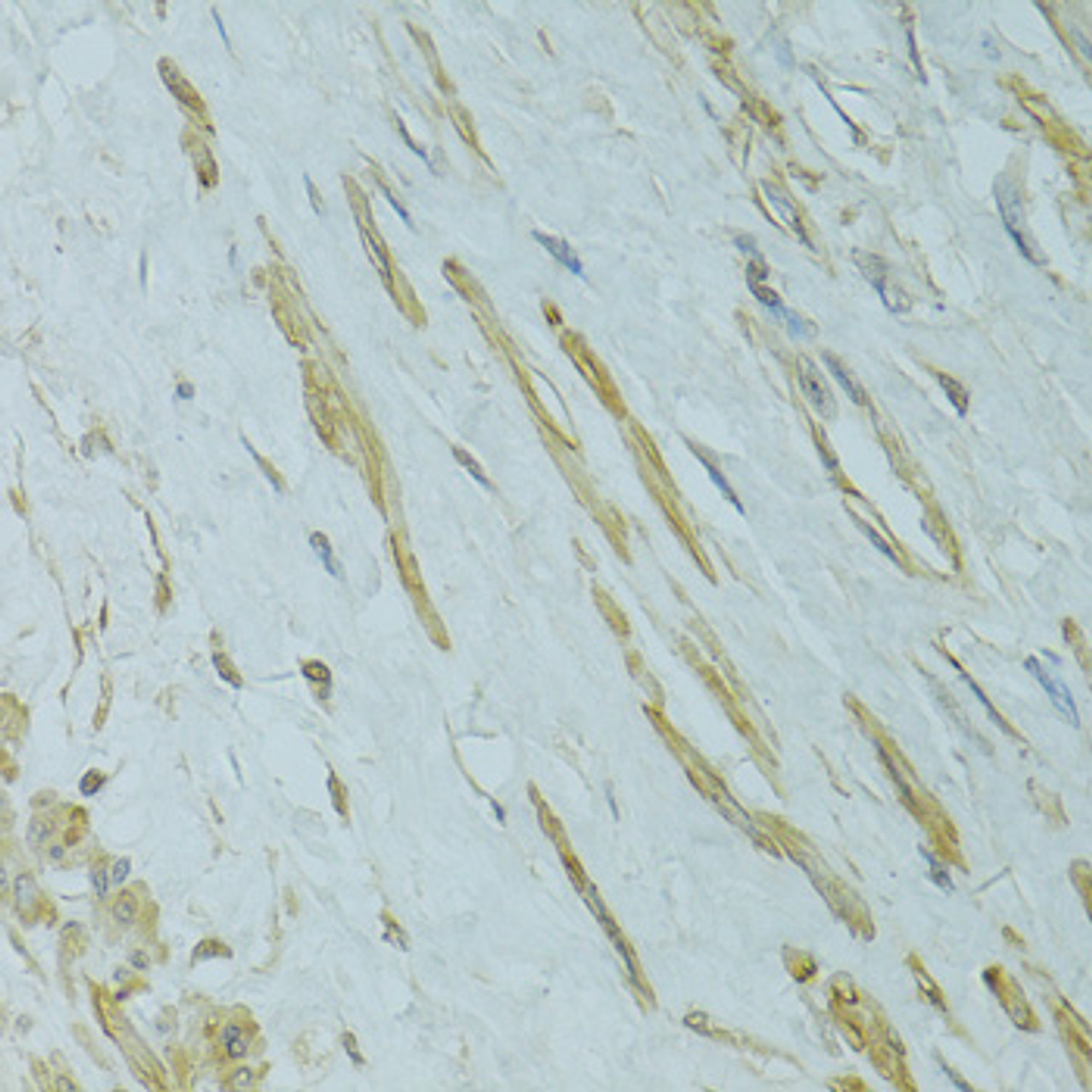 Immunohistochemistry of paraffin-embedded human uterine cancer using IFT57 antibody (15-651) at dilution of 1:100 (40x lens) .