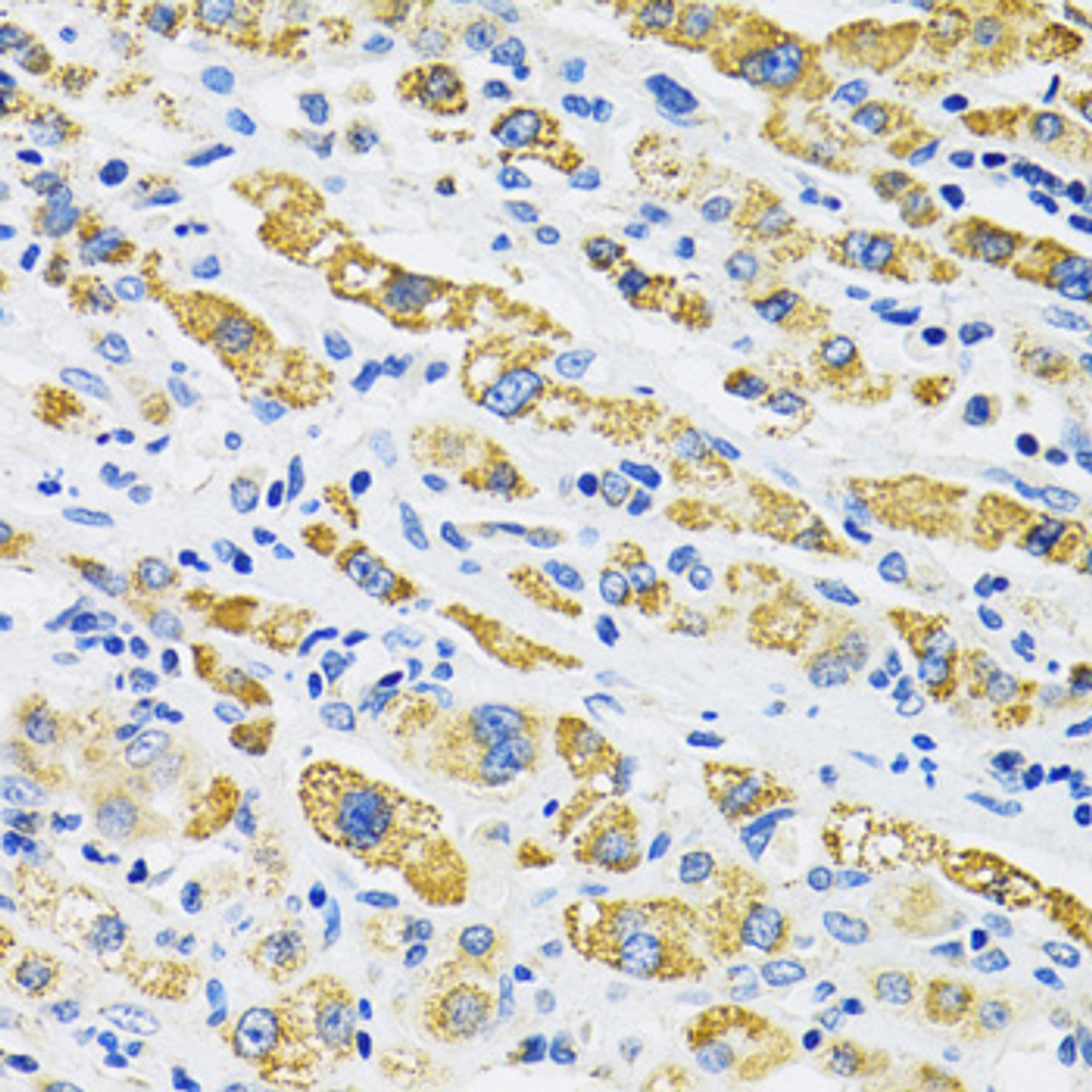 Immunohistochemistry of paraffin-embedded human liver cancer using SLC16A4 antibody (15-745) at dilution of 1:100 (40x lens) .