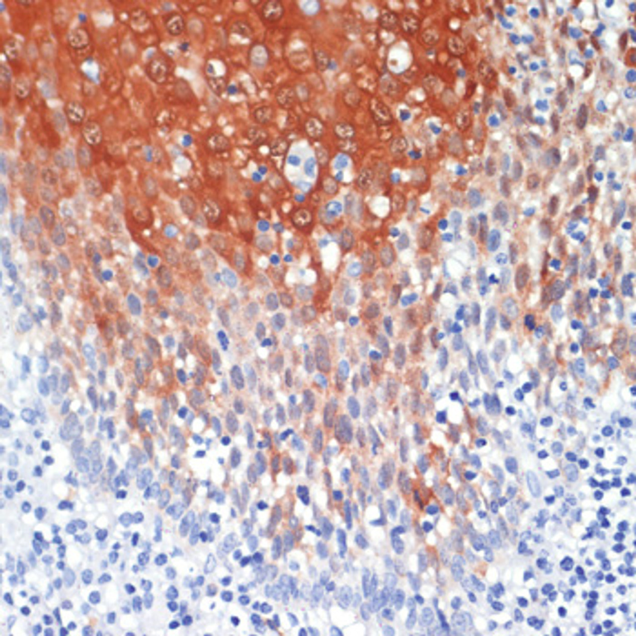 Immunohistochemistry of paraffin-embedded human tonsil using S100A8 antibody (15-986) at dilution of 1:200 (40x lens) .