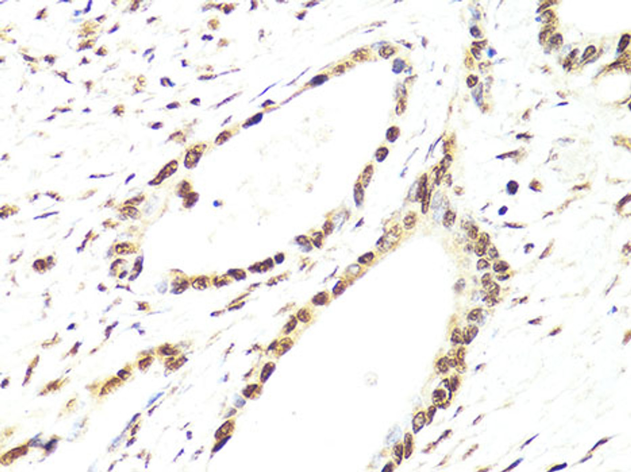 Immunohistochemistry of paraffin-embedded human colon carcinoma using TWIST1 antibody (16-126) at dilution of 1:100 (40x lens) .