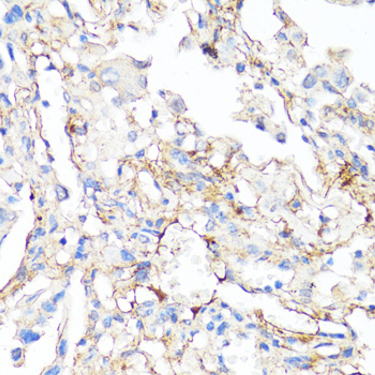 Immunohistochemistry of paraffin-embedded human lung cancer using Fibronectin antibody (16-709) at dilution of 1:100 (40x lens) .