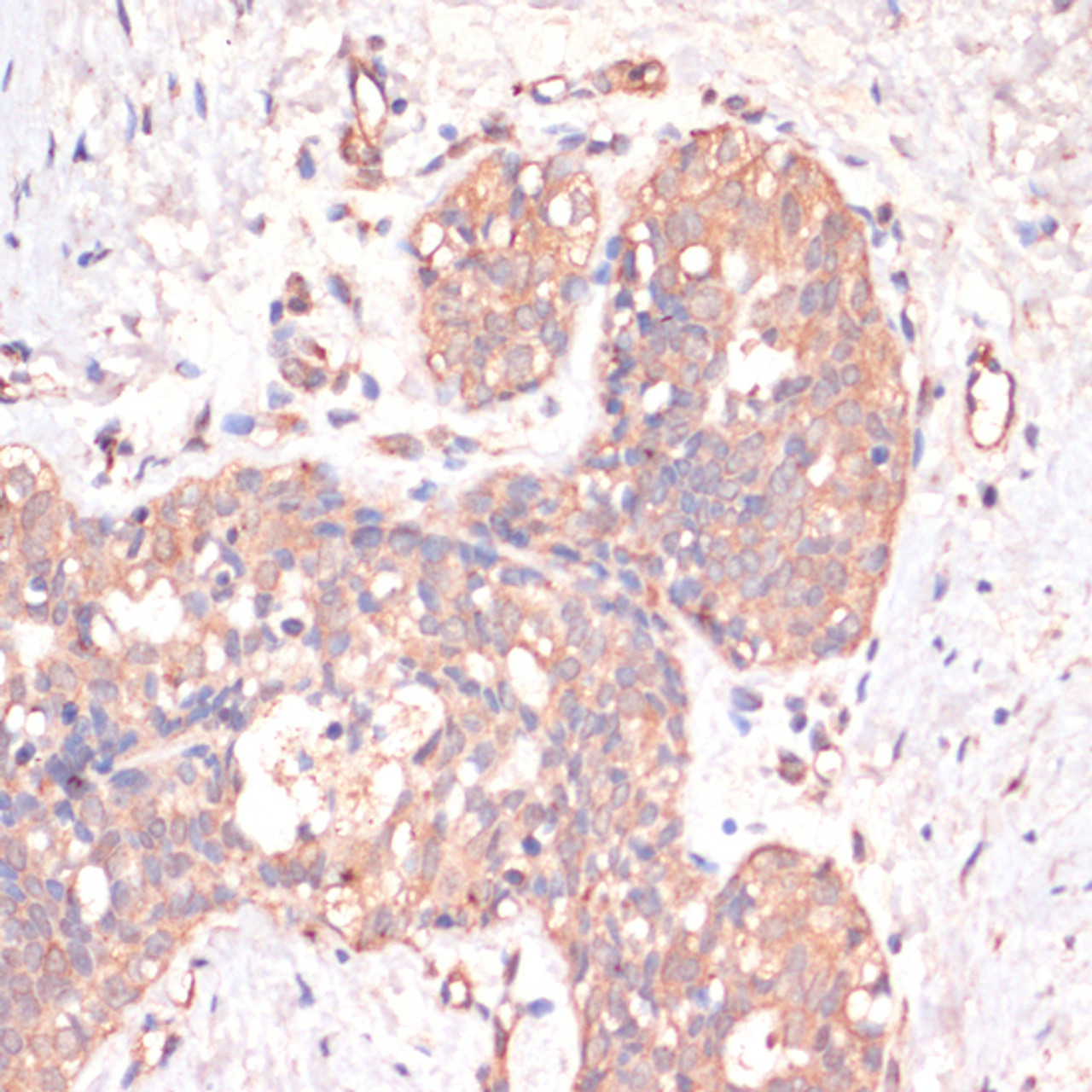 Immunohistochemistry of paraffin-embedded human mammary cancer using Caspase 3 antibody (16-751) at dilution of 1:200 (40x lens) .