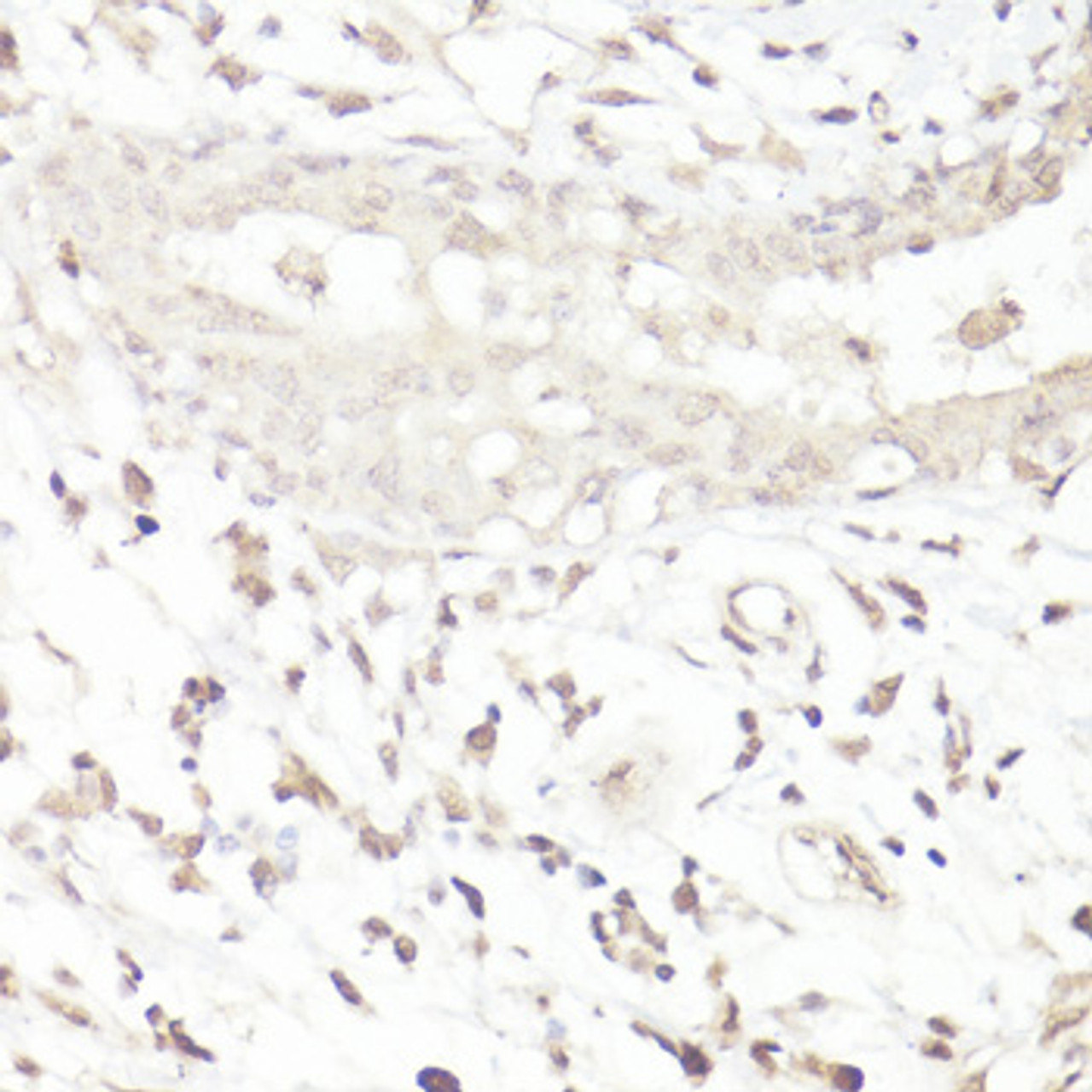 Immunohistochemistry of paraffin-embedded human breast cancer using DMP1 antibody (16-767) at dilution of 1:100 (40x lens) .