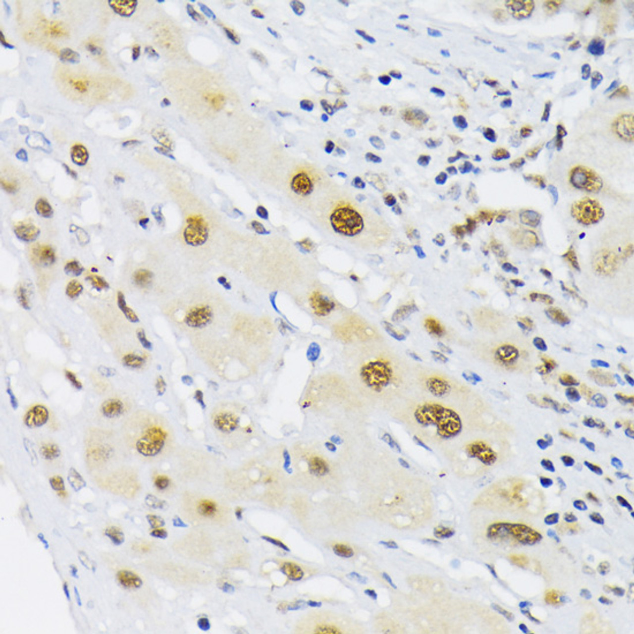 Immunohistochemistry of paraffin-embedded human liver cancer using HIF1A antibody (16-781) at dilution of 1:200 (40x lens) .