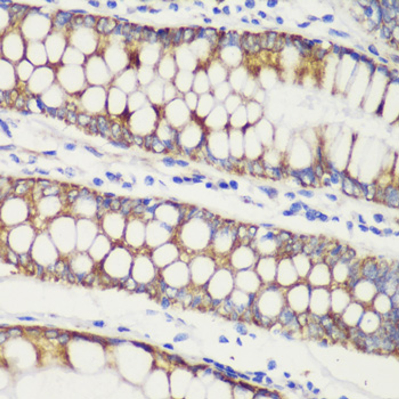 Immunohistochemistry of paraffin-embedded human colon carcinoma using TOM20 antibody (16-790) at dilution of 1:100 (40x lens) .