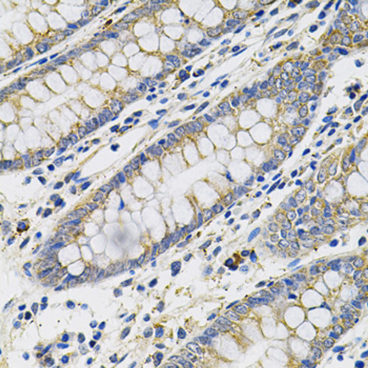 Immunohistochemistry of paraffin-embedded human colon using PLGF Antibody (16-900) at dilution of 1:100 (40x lens) .