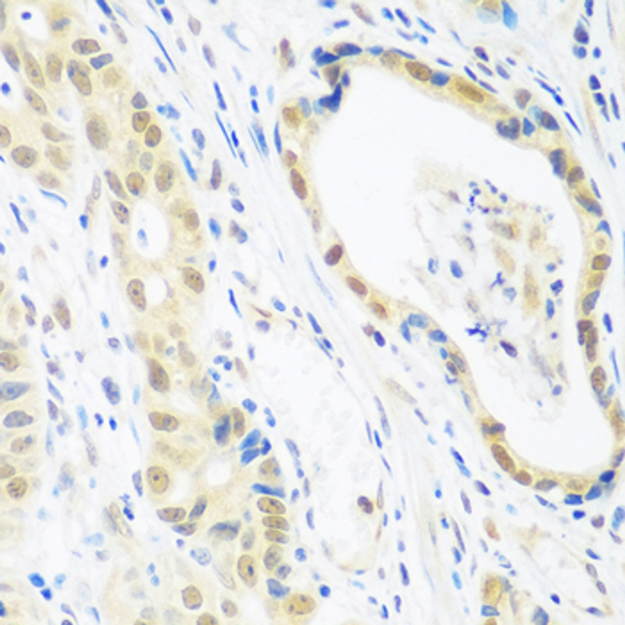 Immunohistochemistry of paraffin-embedded human stomach cancer using POLR2E antibody (16-984) at dilution of 1:100 (40x lens) .