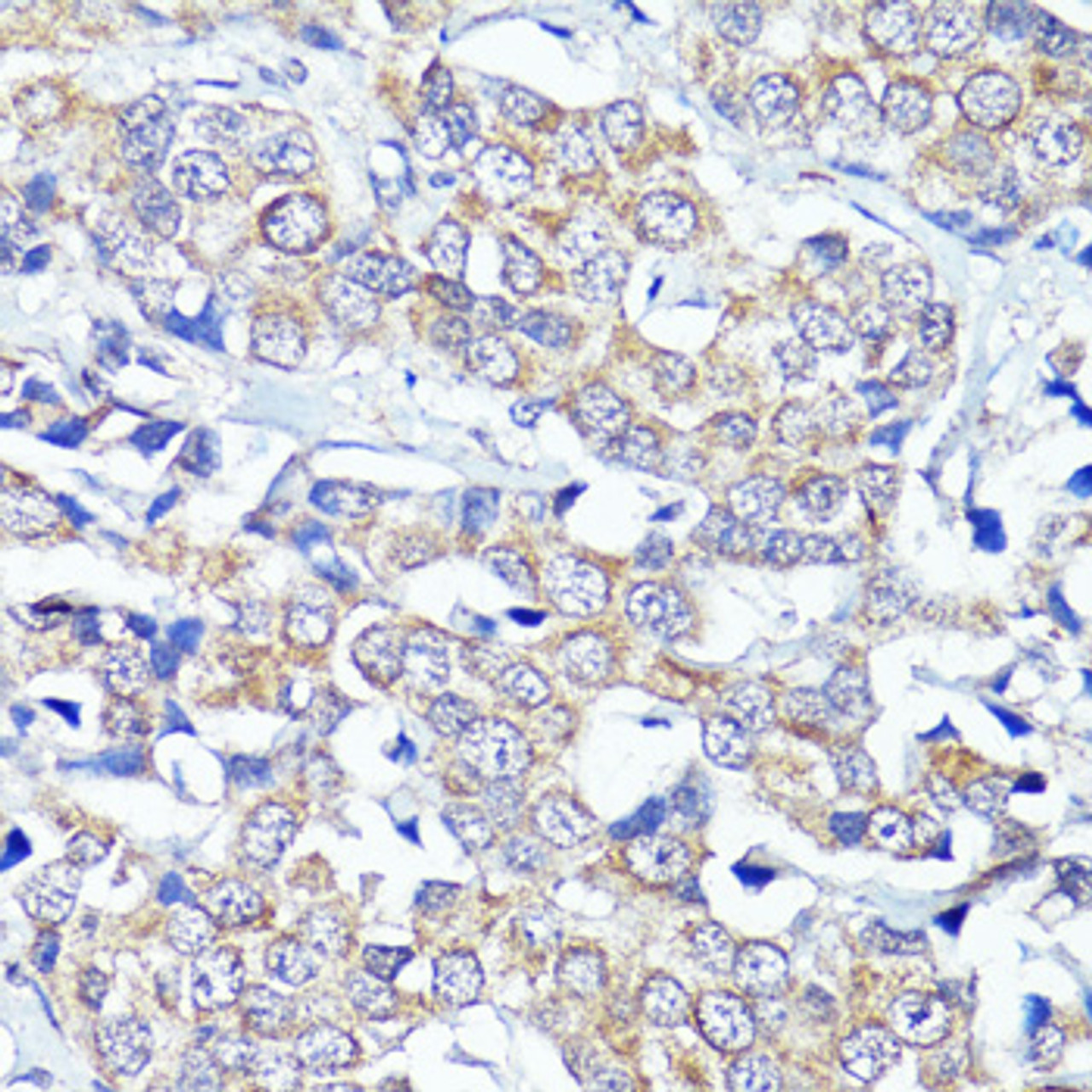 Immunohistochemistry of paraffin-embedded human breast cancer using CNR2 antibody (18-009) at dilution of 1:150 (40x lens) .