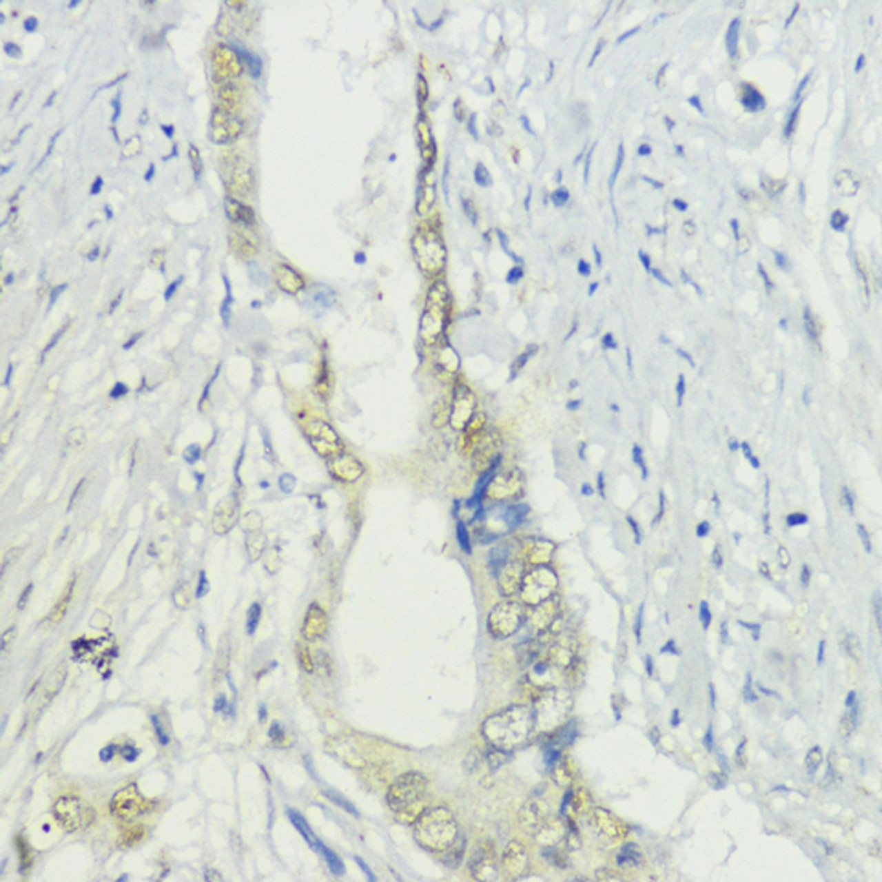 Immunohistochemistry of paraffin-embedded human colon carcinoma using BAZ2A antibody (18-014) at dilution of 1:200 (40x lens) .