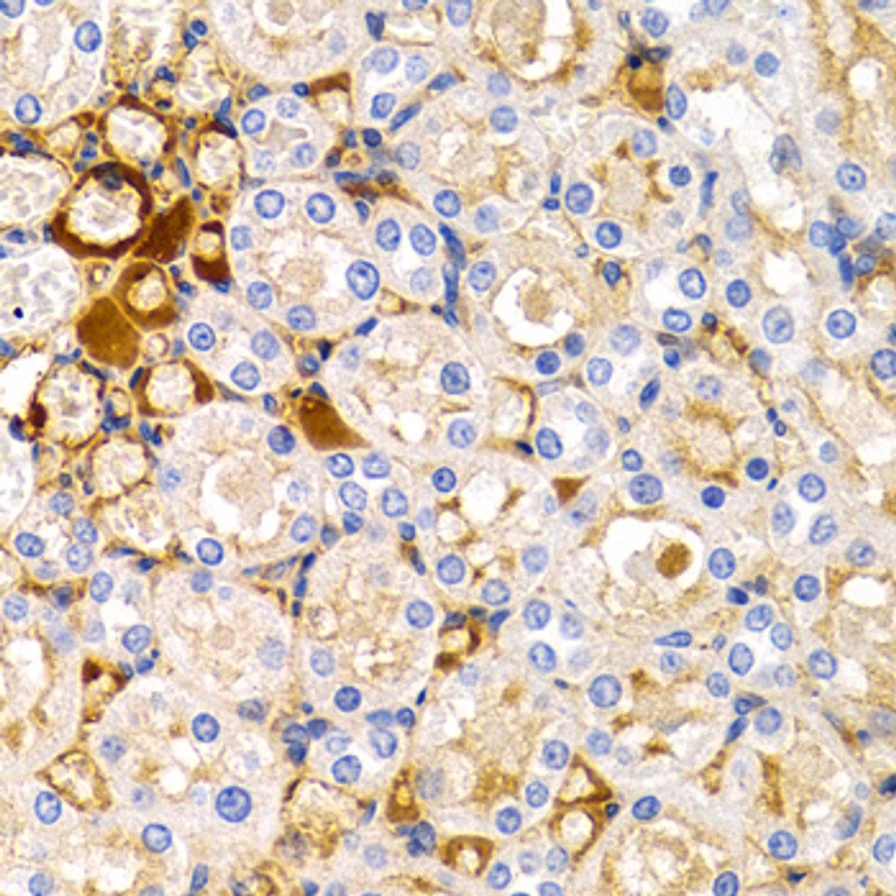 Immunohistochemistry of paraffin-embedded human breast cancer using TFF1 antibody (18-153) at dilution of 1:200 (40x lens) .