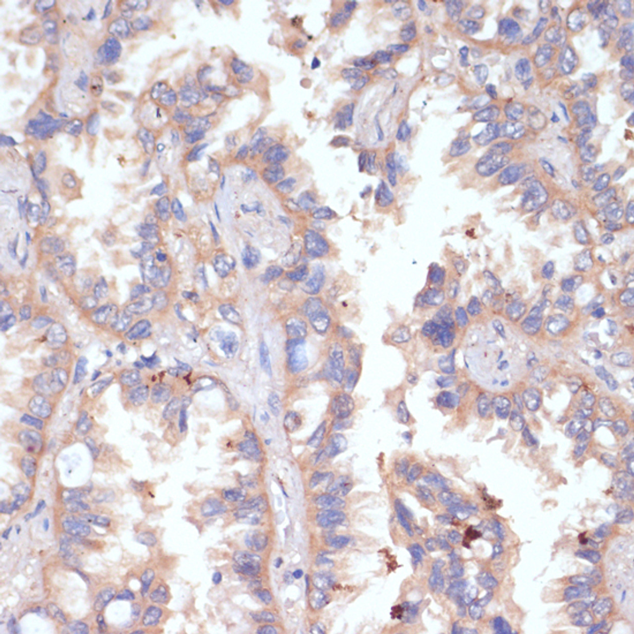 Immunohistochemistry of paraffin-embedded human lung cancer using CD47 antibody (18-341) at dilution of 1:200 (40x lens) .