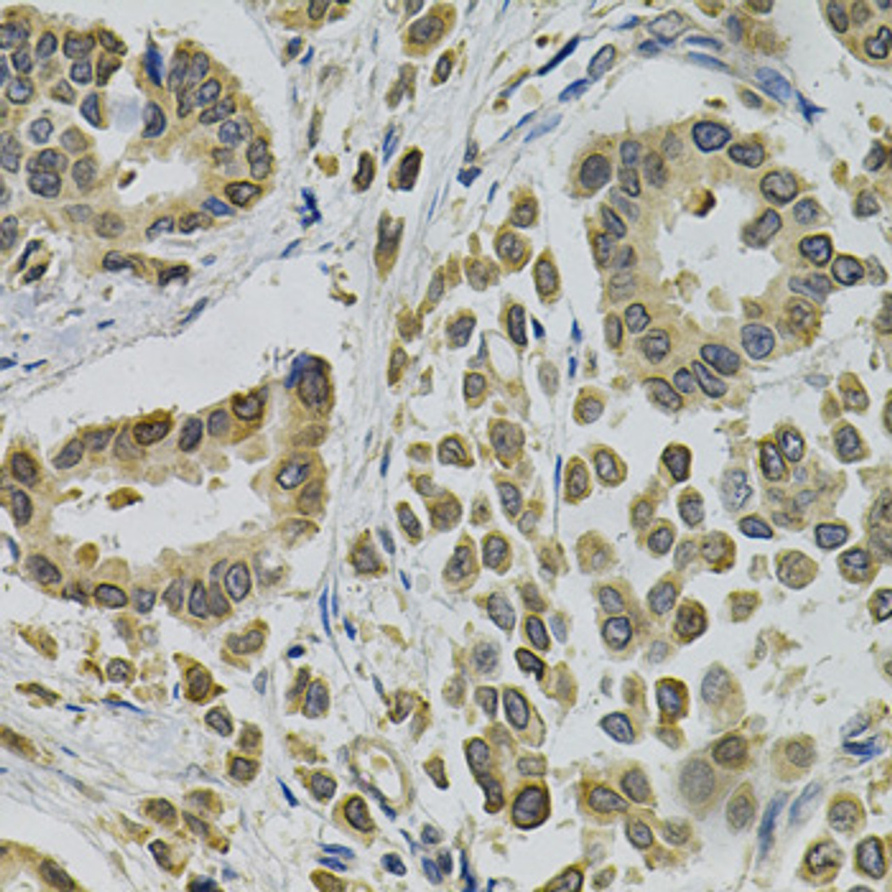 Immunohistochemistry of paraffin-embedded human breast cancer using EBAG9 Antibody (18-398) at dilution of 1:100 (40x lens) .