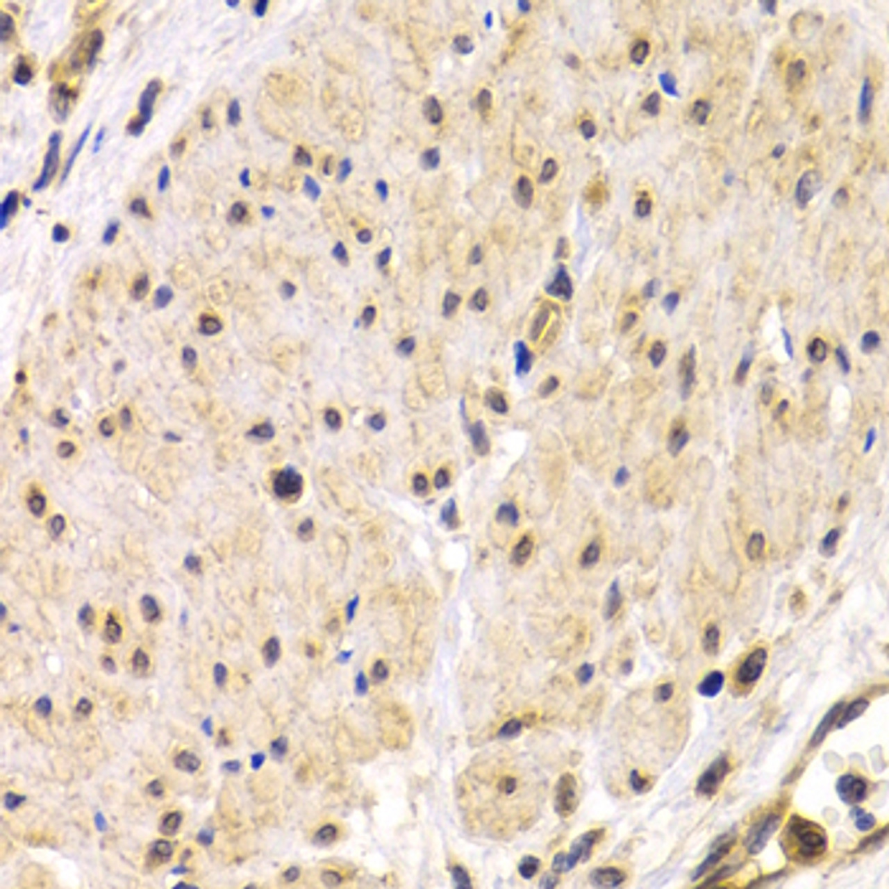 Immunohistochemistry of paraffin-embedded human stomach cancer using TMPRSS2 antibody (18-426) at dilution of 1:200 (40x lens) .