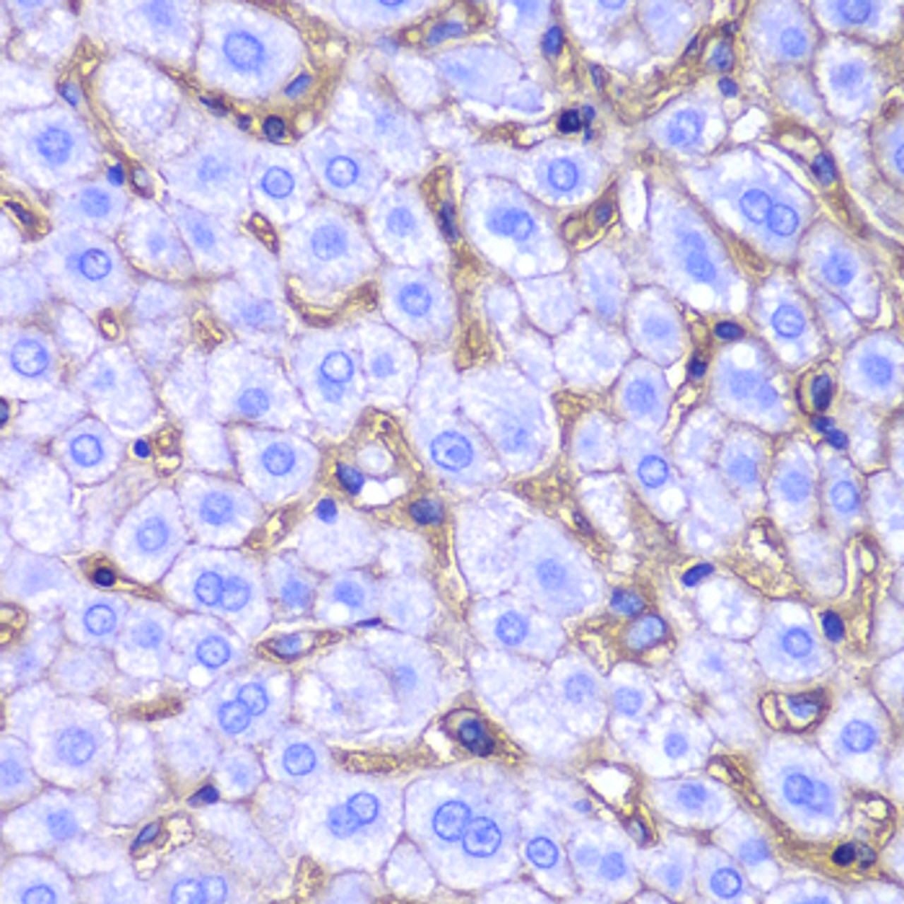 Immunohistochemistry of paraffin-embedded human liver damage using HLA-A antibody (18-549) at dilution of 1:100 (40x lens) .