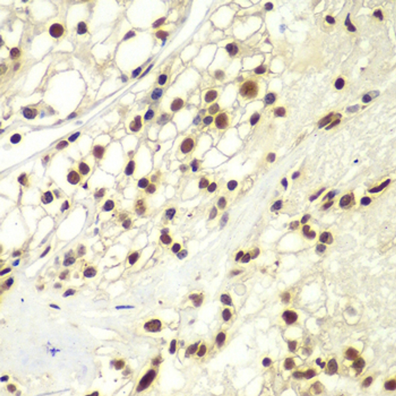 Immunohistochemistry of paraffin-embedded human kidney cancer using RPA2 Antibody (18-562) at dilution of 1:100 (40x lens) .