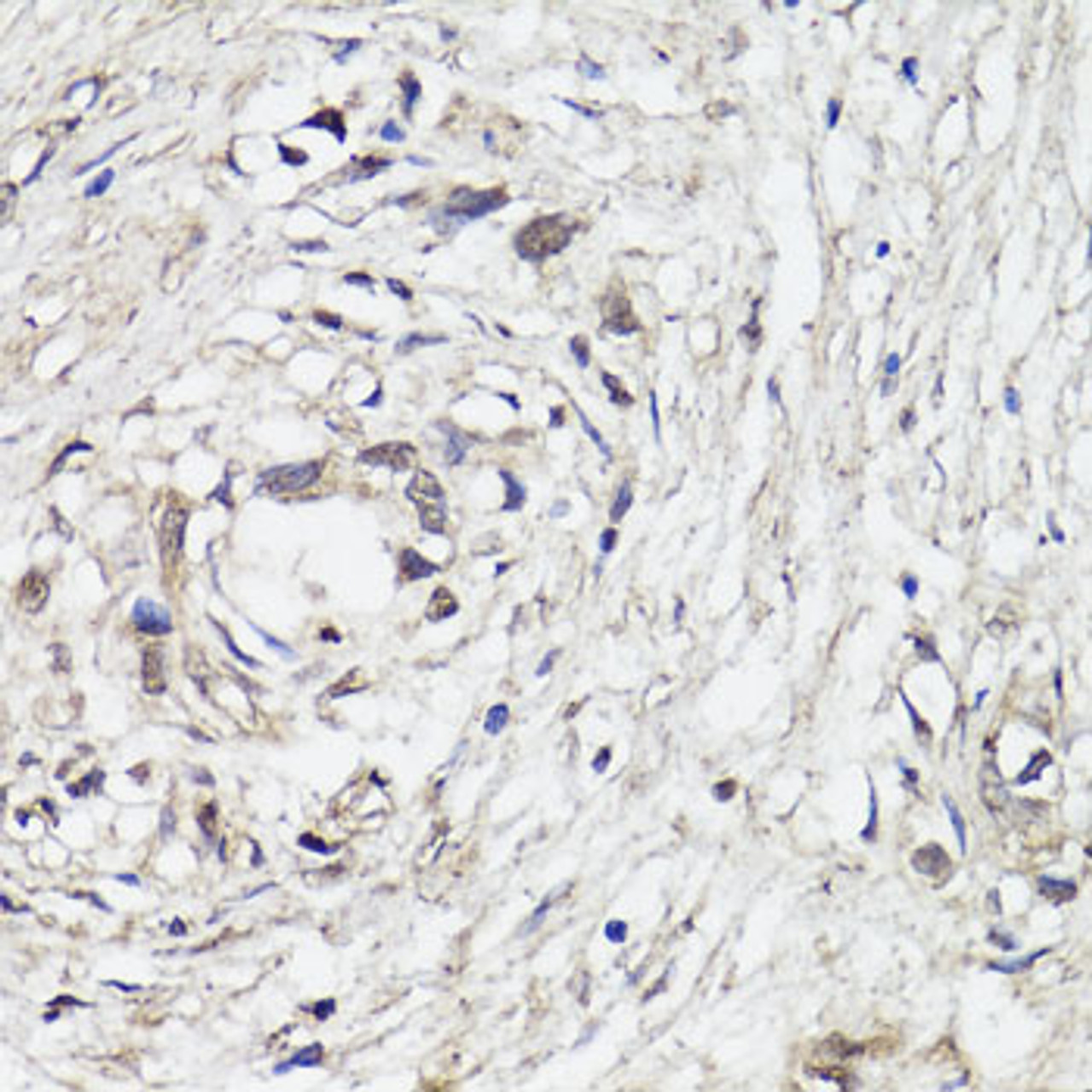 Immunohistochemistry of paraffin-embedded human gastric cancer using C-FOS antibody (18-650) at dilution of 1:150 (40x lens) .