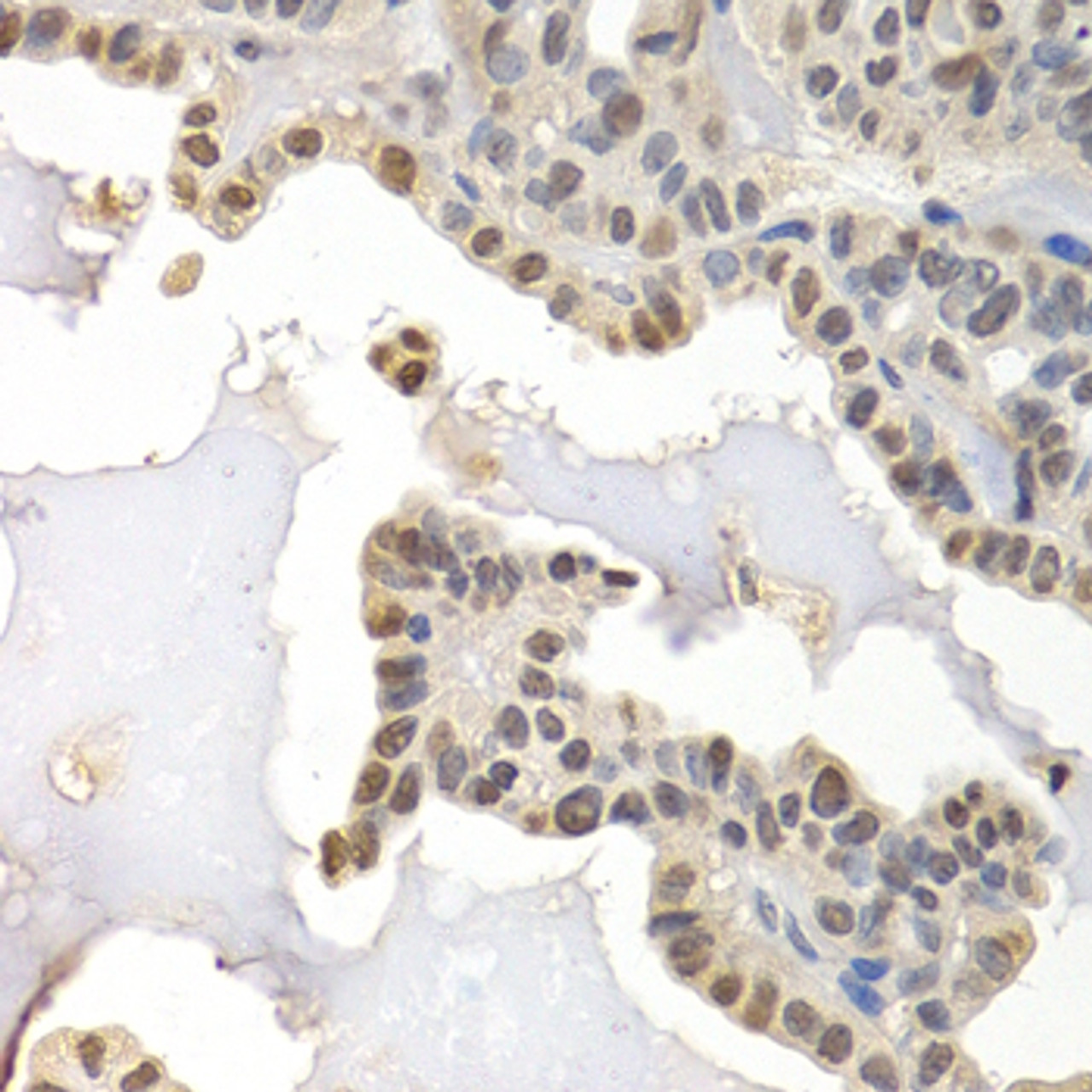 Immunohistochemistry of paraffin-embedded human thyroid cancer using GTF2F1 antibody (18-663) at dilution of 1:200 (40x lens) .