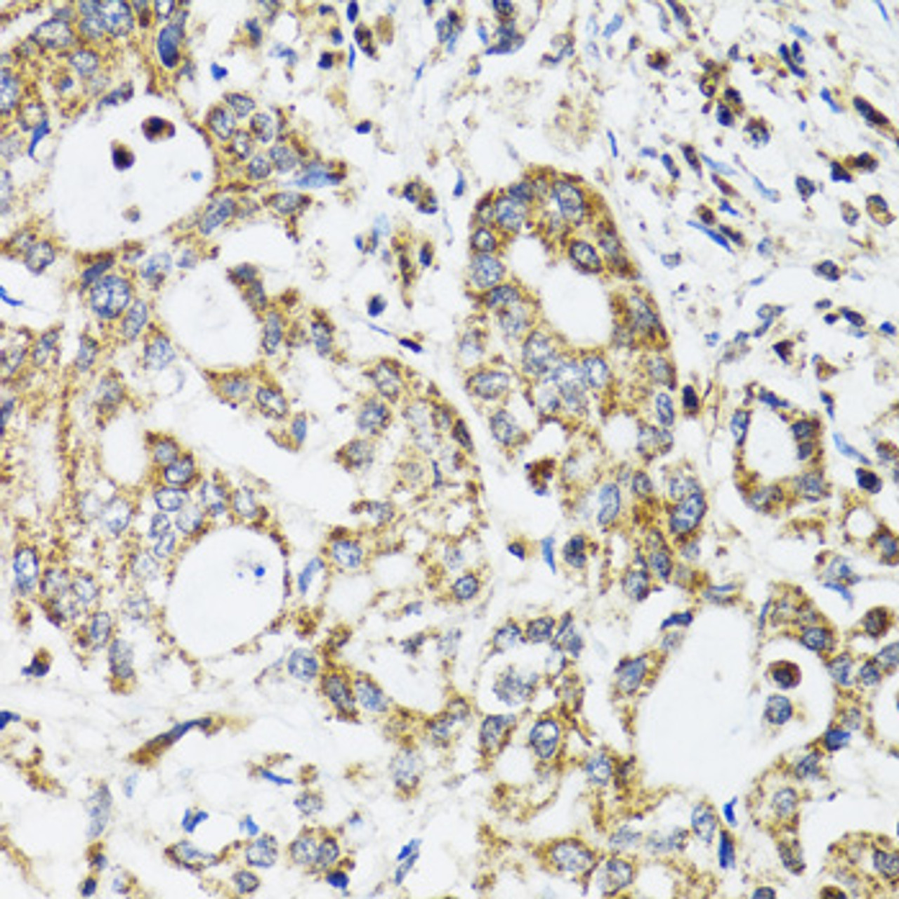 Immunohistochemistry of paraffin-embedded human colon carcinoma using EPB41 antibody (18-664) at dilution of 1:100 (40x lens) .