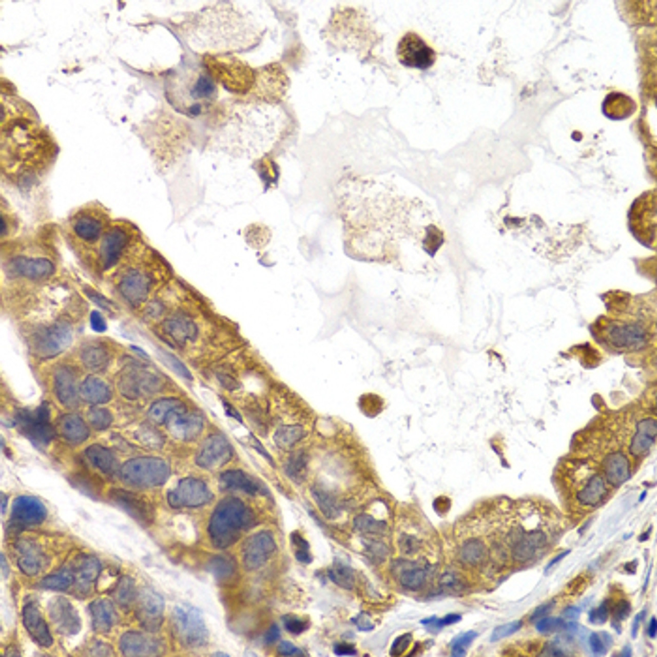 Immunohistochemistry of paraffin-embedded human stomach cancer using GYS1 antibody (18-683) at dilution of 1:200 (40x lens) .