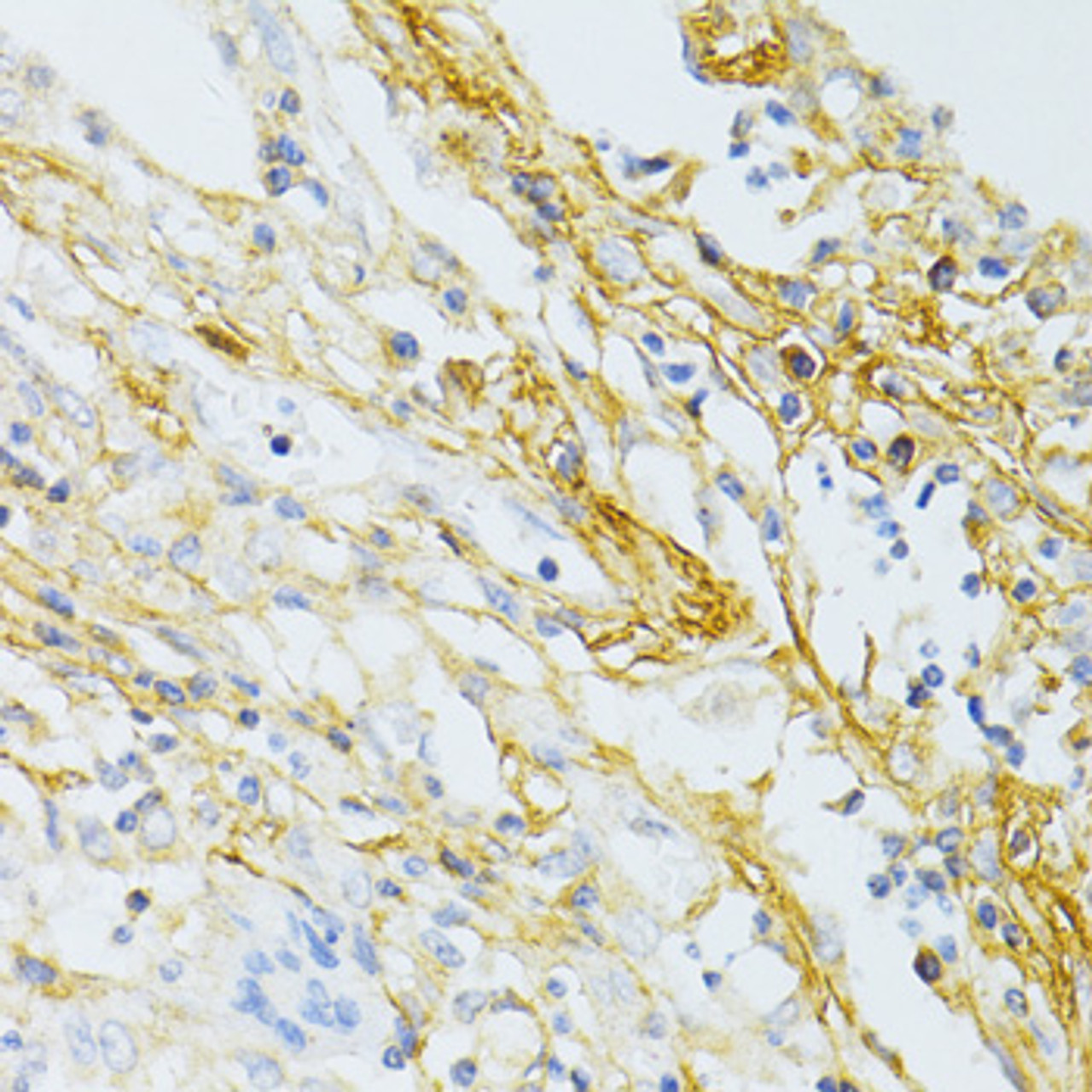 Immunohistochemistry of paraffin-embedded human lung cancer using TGFBI antibody (18-712) at dilution of 1:100 (40x lens) .
