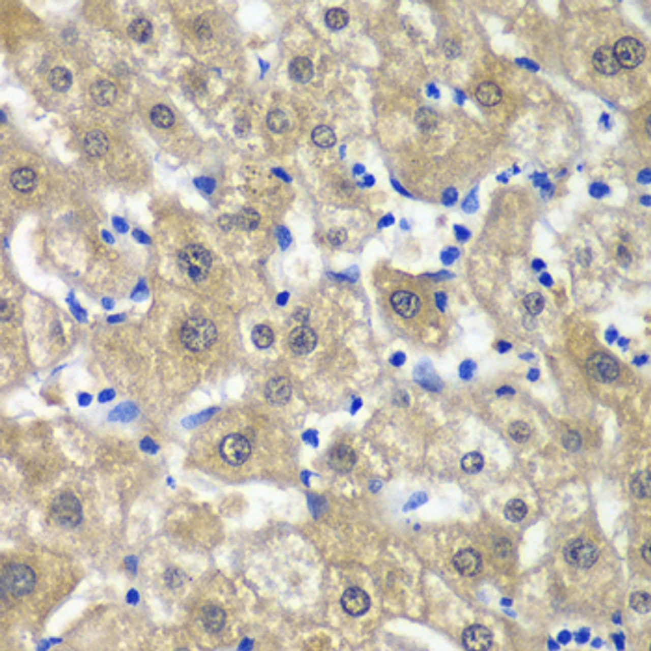 Immunohistochemistry of paraffin-embedded human liver damage using MAT1A antibody (18-744) at dilution of 1:100 (40x lens) .