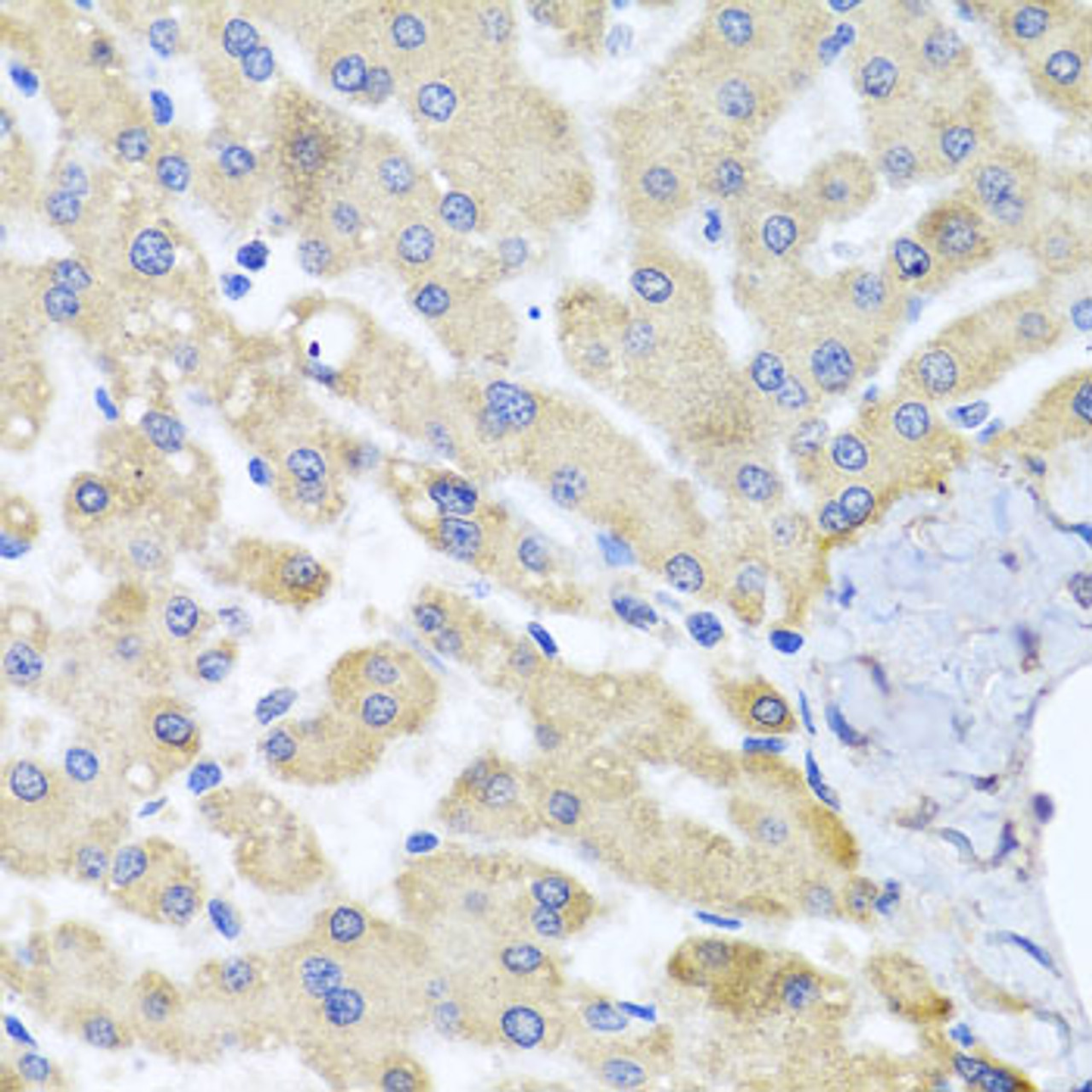 Immunohistochemistry of paraffin-embedded human liver damage using ABCB8 antibody (18-750) at dilution of 1:100 (40x lens) .