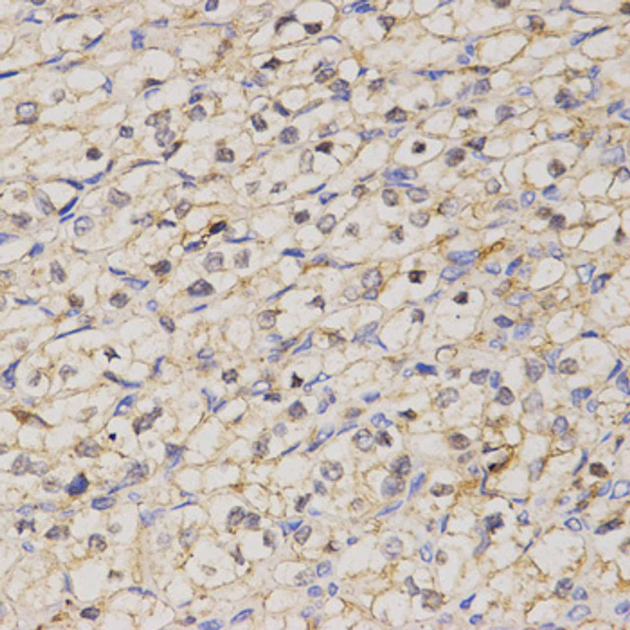 Immunohistochemistry of paraffin-embedded human kidney cancer using GJC2 antibody (18-848) at dilution of 1:200 (40x lens) .