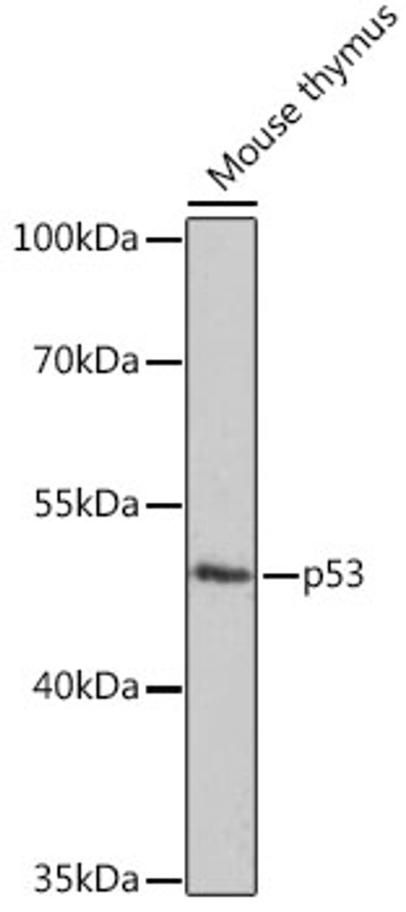 Immunohistochemistry of paraffin-embedded human gastric cancer using p53 Antibody (18-984) at dilution of 1:100 (40x lens) .