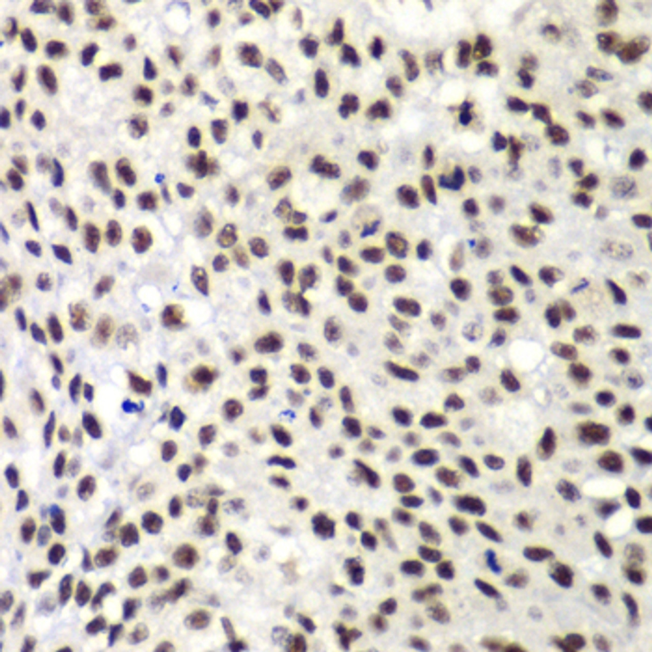 Immunohistochemistry of paraffin-embedded human lung cancer using NELFE antibody (19-008) at dilution of 1:100 (40x lens) .