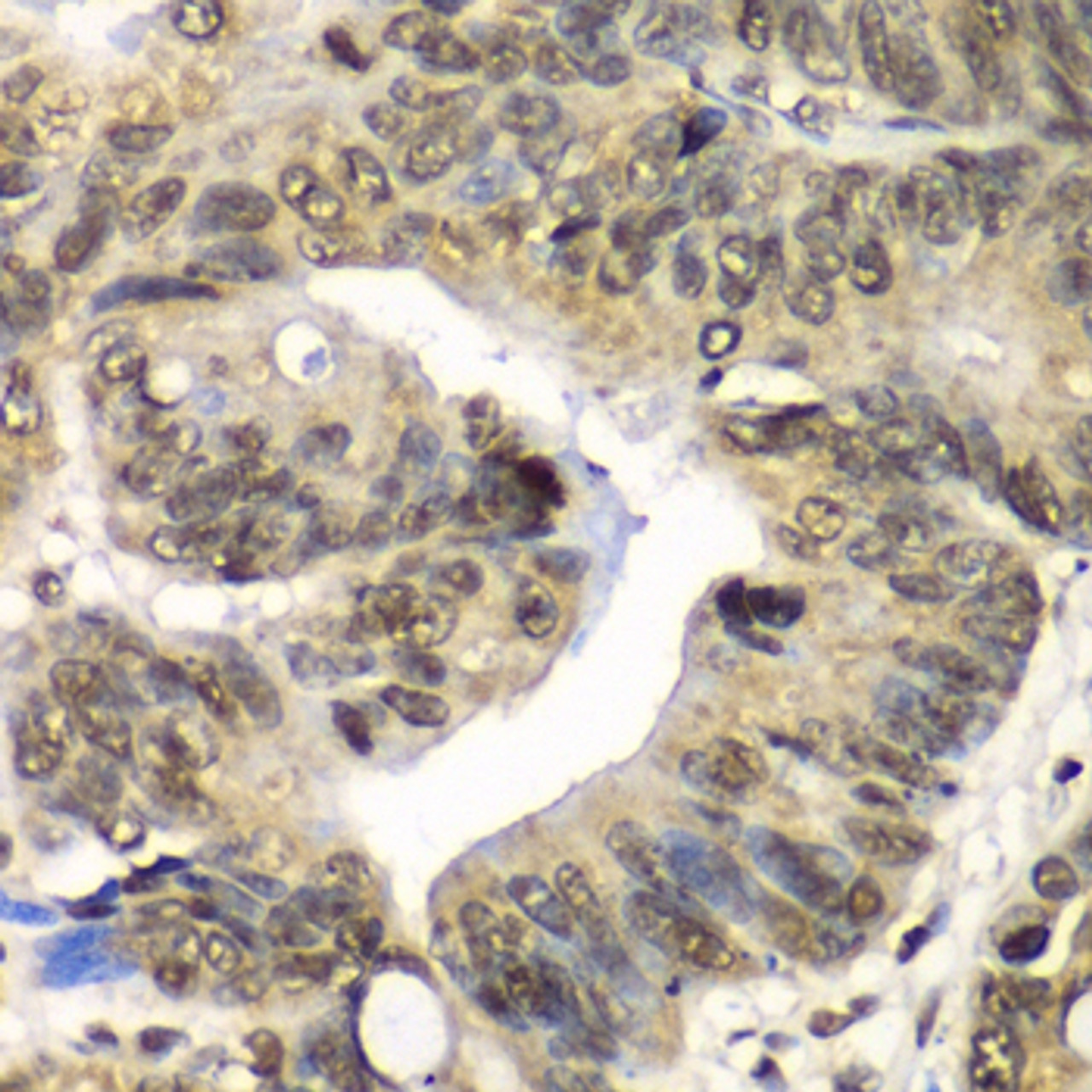 Immunohistochemistry of paraffin-embedded human colon using UFD1L antibody (19-009) at dilution of 1:100 (40x lens) .