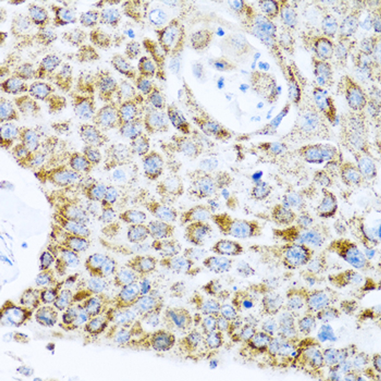 Immunohistochemistry of paraffin-embedded human lung cancer using LRPPRC antibody (19-047) at dilution of 1:100 (40x lens) .