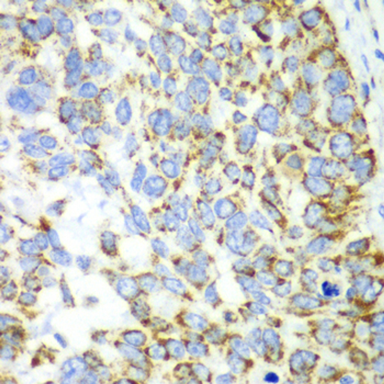 Immunohistochemistry of paraffin-embedded human esophageal cancer using CHIA antibody (19-061) at dilution of 1:100 (40x lens) .