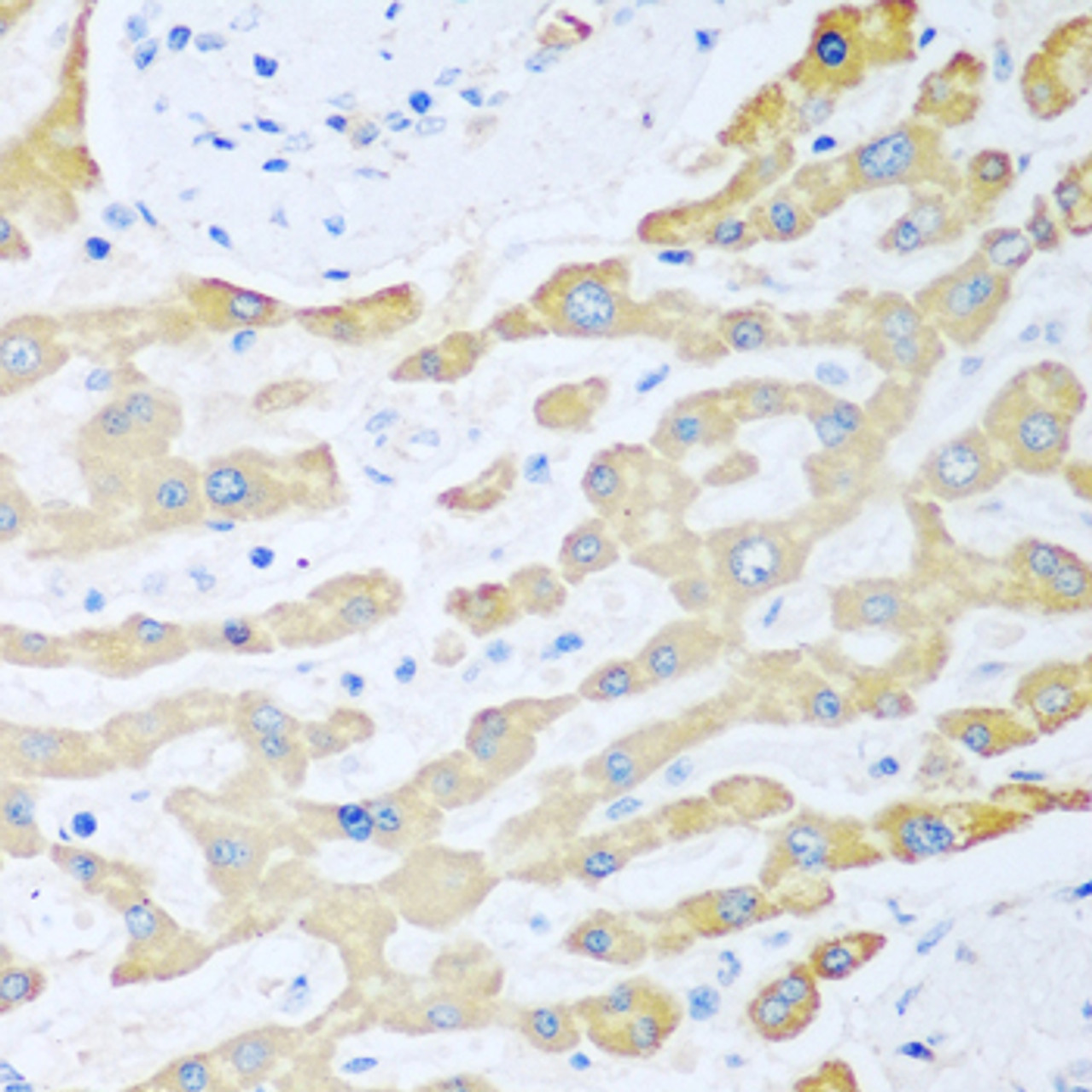 Immunohistochemistry of paraffin-embedded human liver cancer using FDXR antibody (19-187) at dilution of 1:100 (40x lens) .