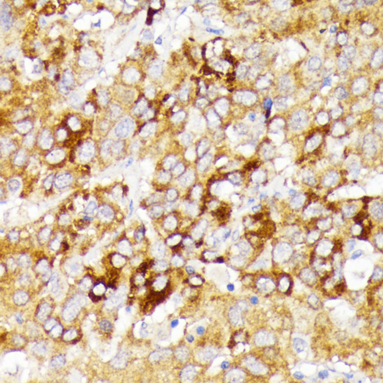 Immunohistochemistry of paraffin-embedded human liver cancer using GALC antibody (19-192) at dilution of 1:100 (40x lens) .