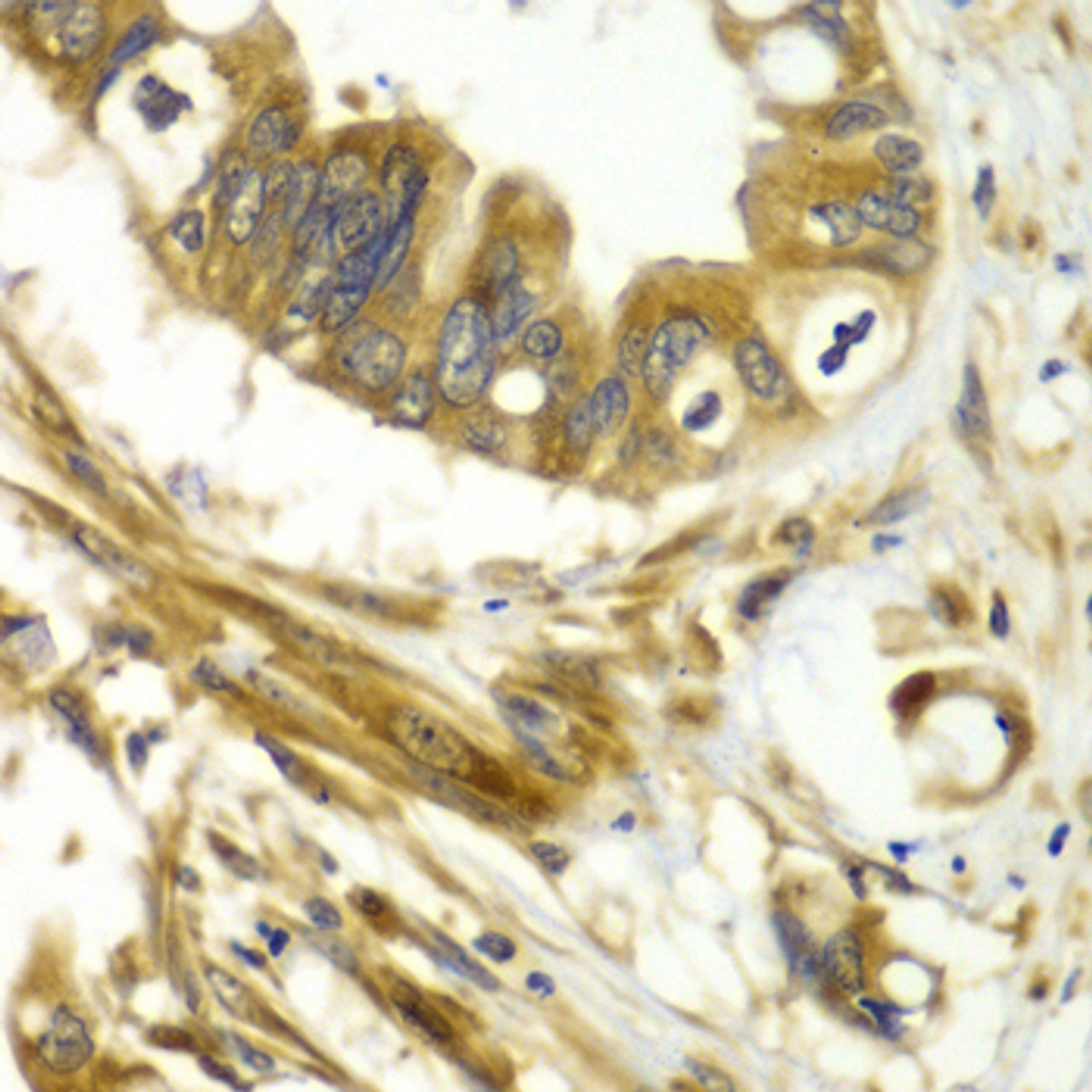 Immunohistochemistry of paraffin-embedded human liver cancer using GBP1 antibody (19-195) at dilution of 1:100 (40x lens) .