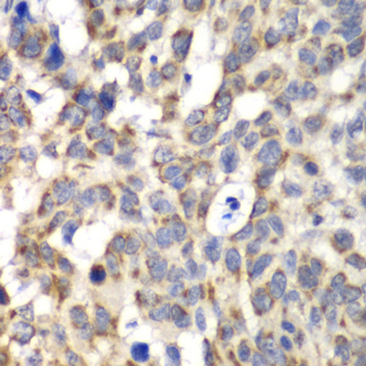 Immunohistochemistry of paraffin-embedded human esophageal cancer using PARN antibody (19-242) at dilution of 1:100 (40x lens) .