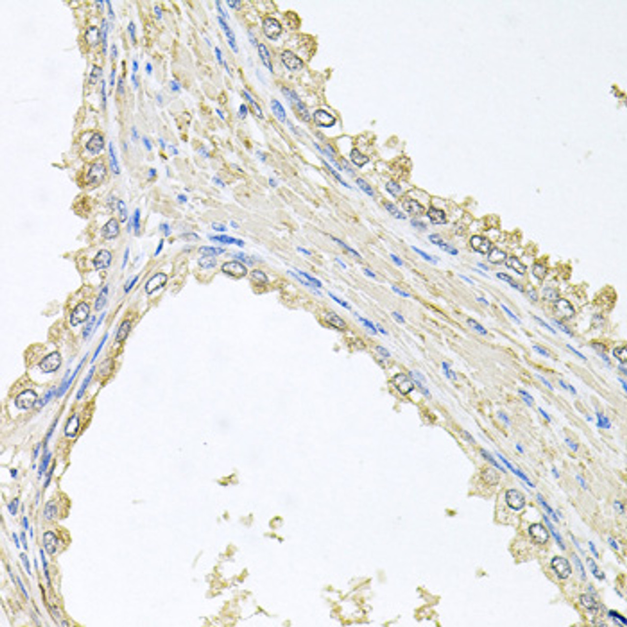 Immunohistochemistry of paraffin-embedded human prostate using PMM2 antibody (19-250) at dilution of 1:100 (40x lens) .