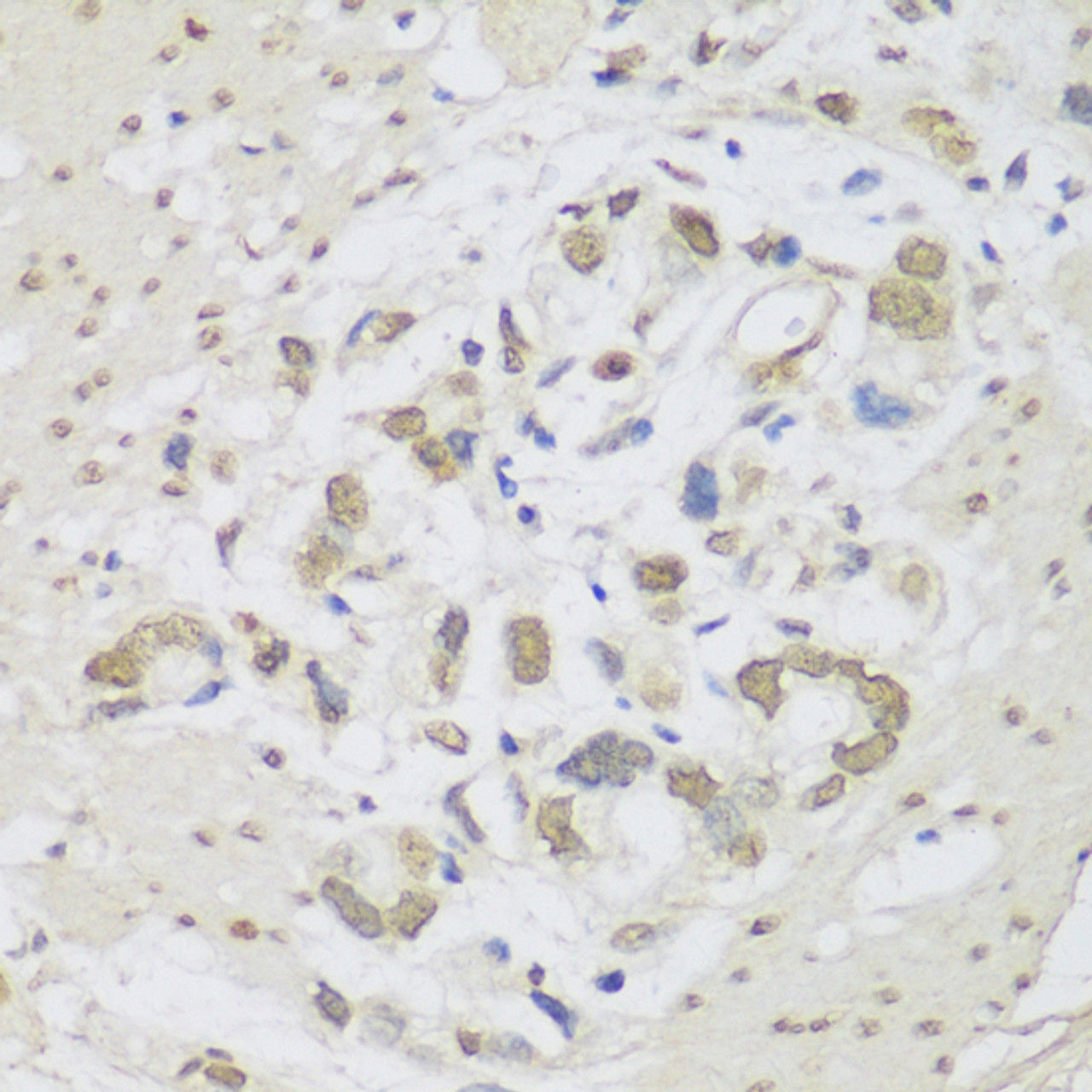 Immunohistochemistry of paraffin-embedded human gastric cancer using DHX38 antibody (19-349) at dilution of 1:150 (40x lens) .