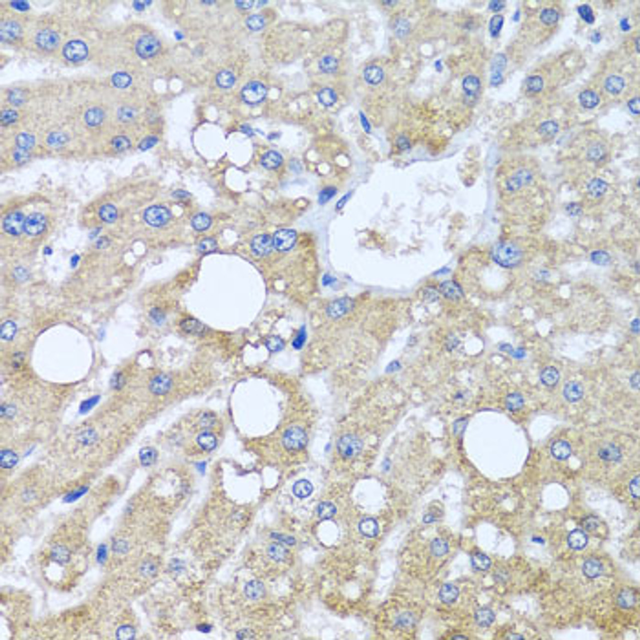 Immunohistochemistry of paraffin-embedded human liver damage using TUBGCP3 antibody (19-362) at dilution of 1:100 (40x lens) .