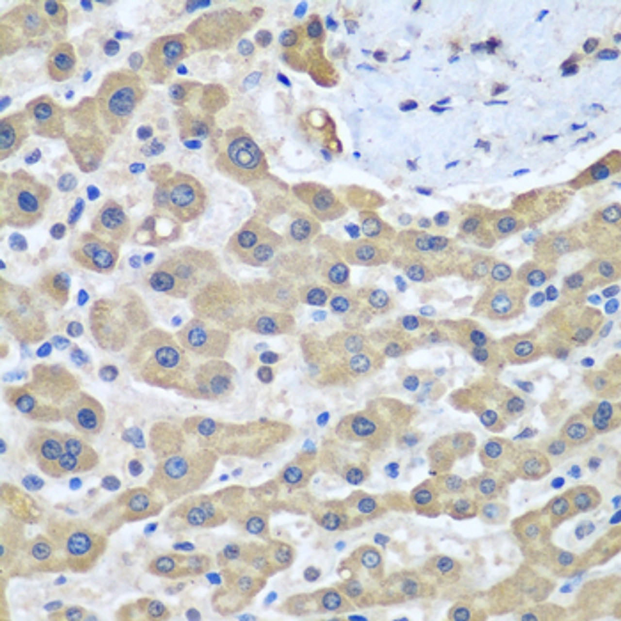 Immunohistochemistry of paraffin-embedded human liver cancer using GFM1 antibody (19-530) at dilution of 1:100 (40x lens) .
