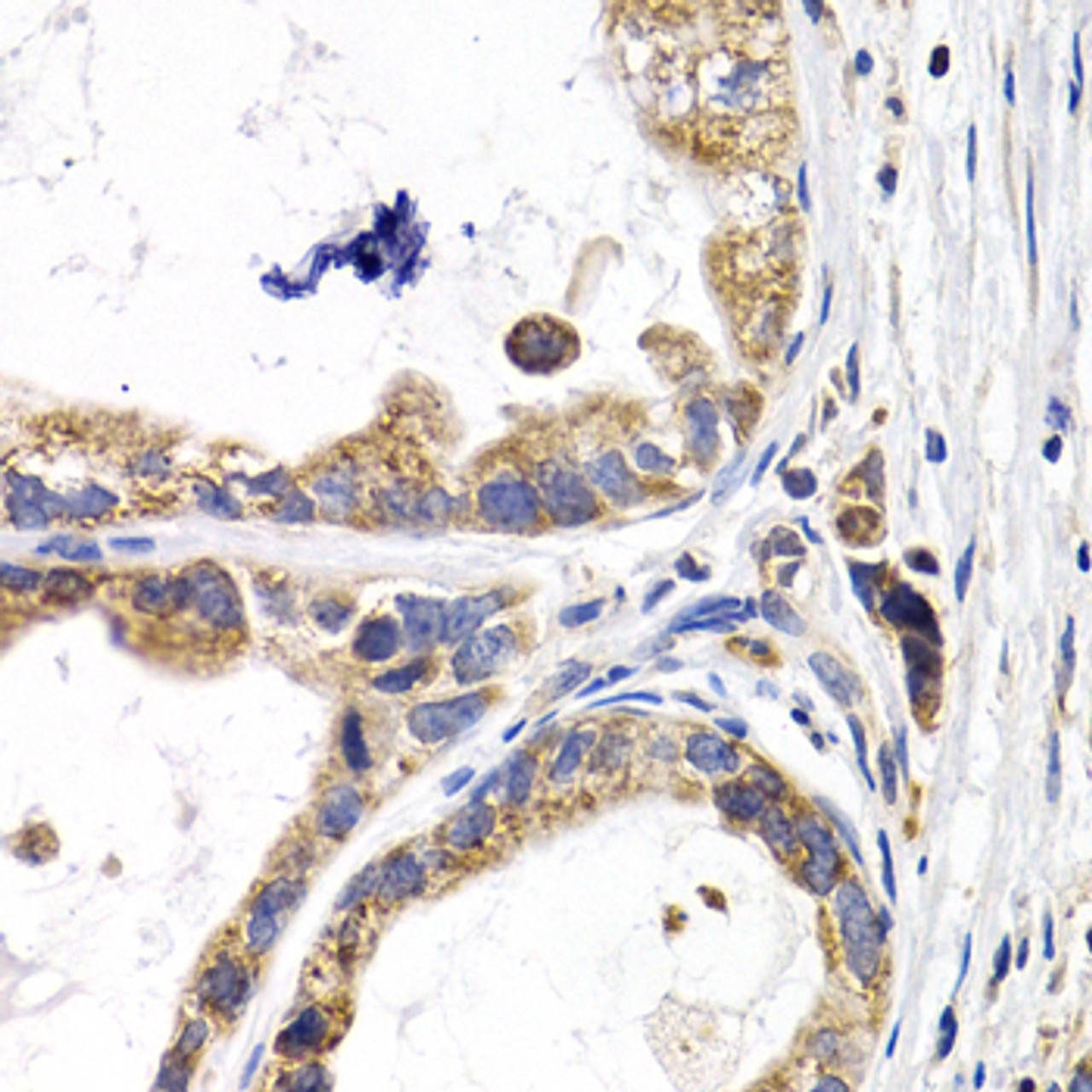 Immunohistochemistry of paraffin-embedded human stomach cancer using FABP3 antibody (19-580) at dilution of 1:200 (40x lens) .